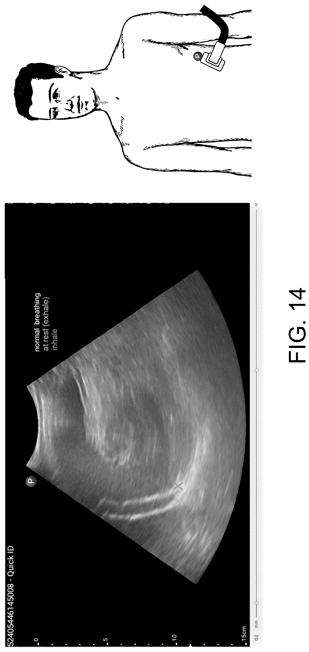 Patent US12611555 Figure 16 – Systems and methods for targeting an organ with ultrasound stimulation for treating inflammation