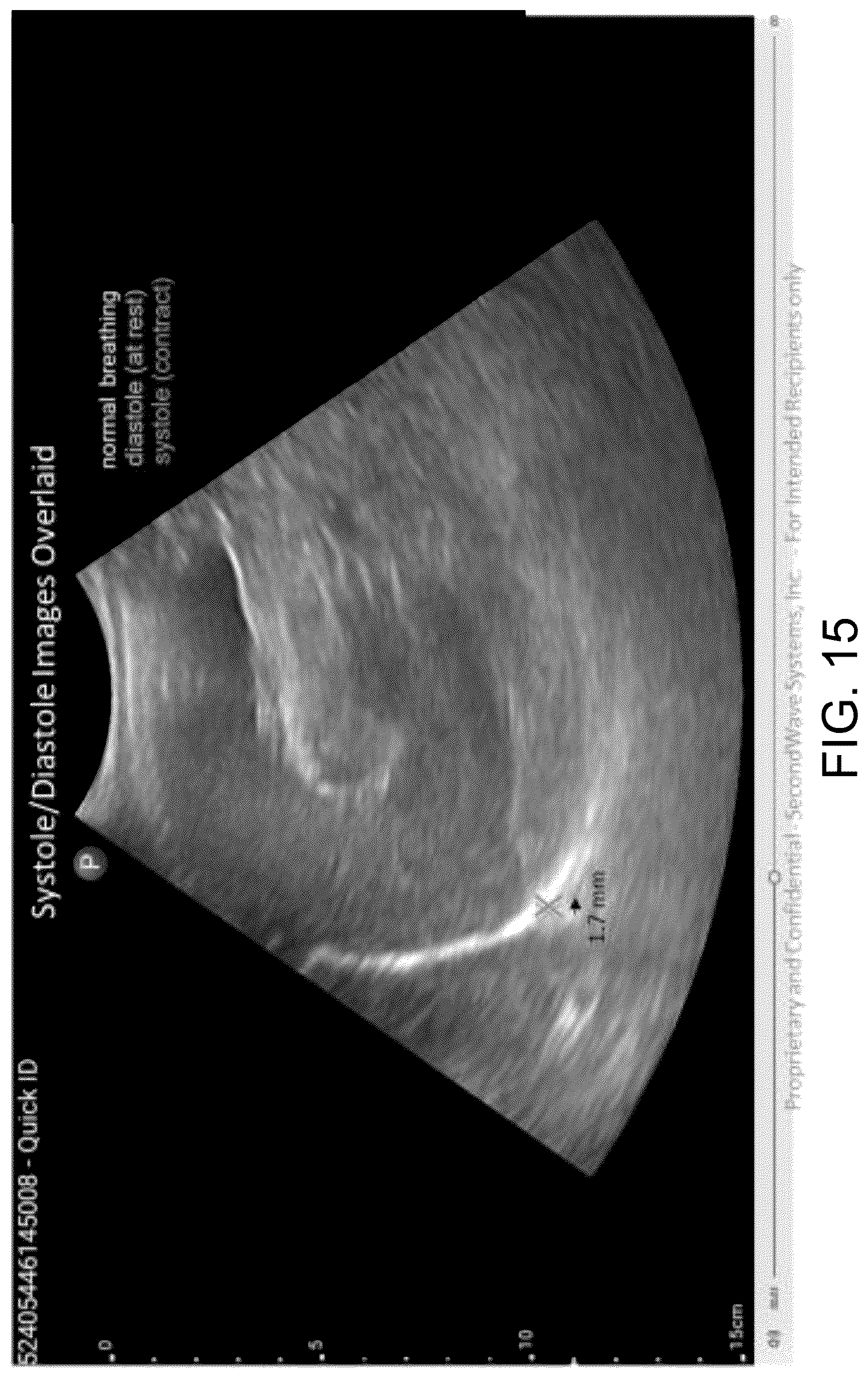 Patent US12611555 Figure 17 – Systems and methods for targeting an organ with ultrasound stimulation for treating inflammation