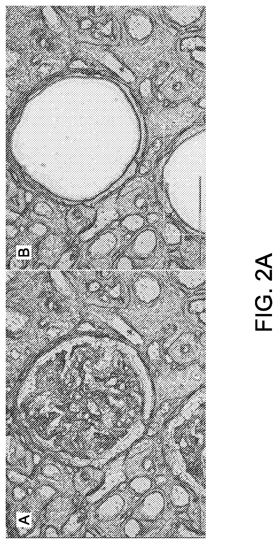 Patent US12612464 Figure 2 – Autoantibody specifically binding to NELL-1 and elevated NELL-1 polypeptide levels for identifying and treating membranous nephropathy
