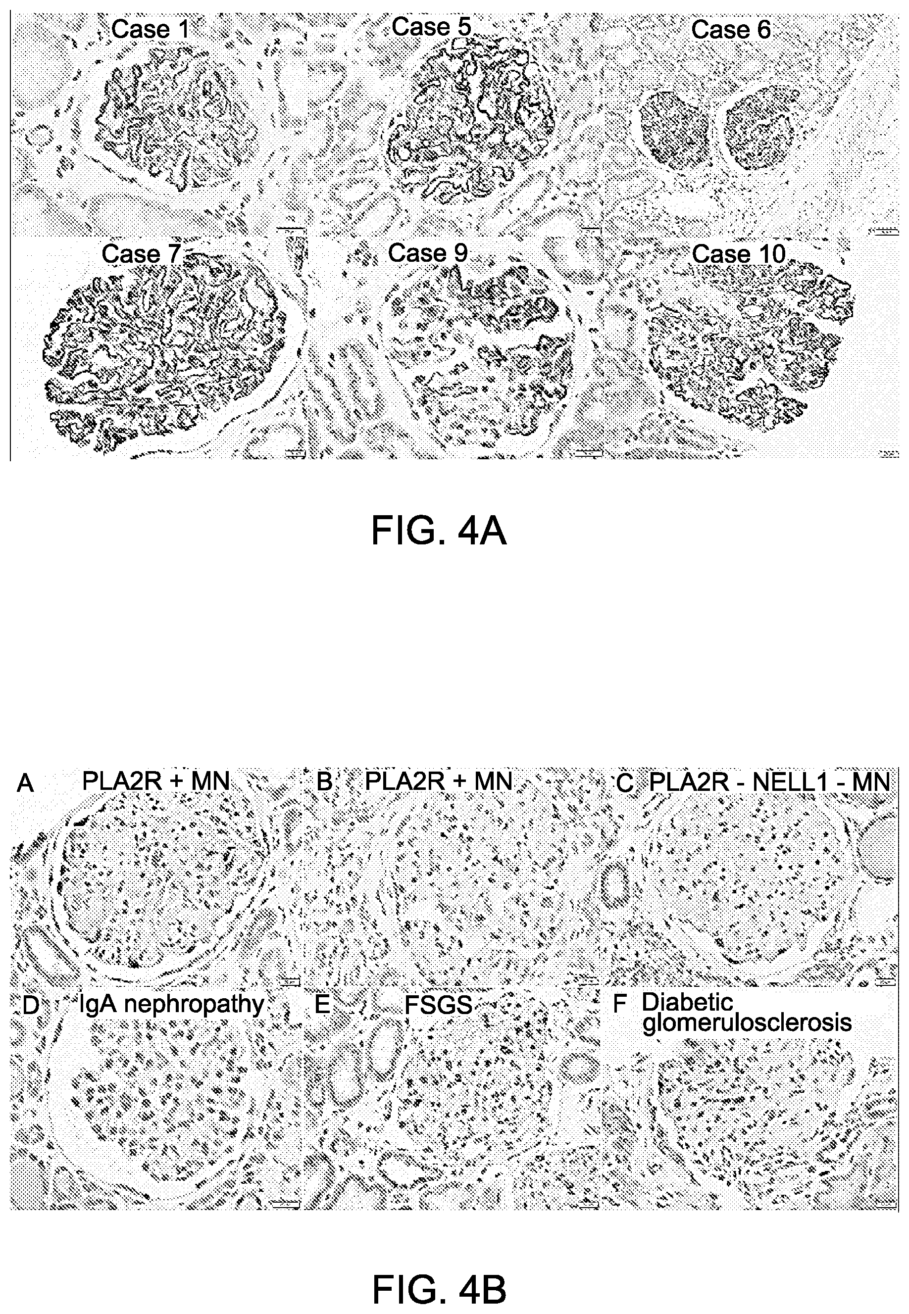 Patent US12612464 Figure 6 – Autoantibody specifically binding to NELL-1 and elevated NELL-1 polypeptide levels for identifying and treating membranous nephropathy