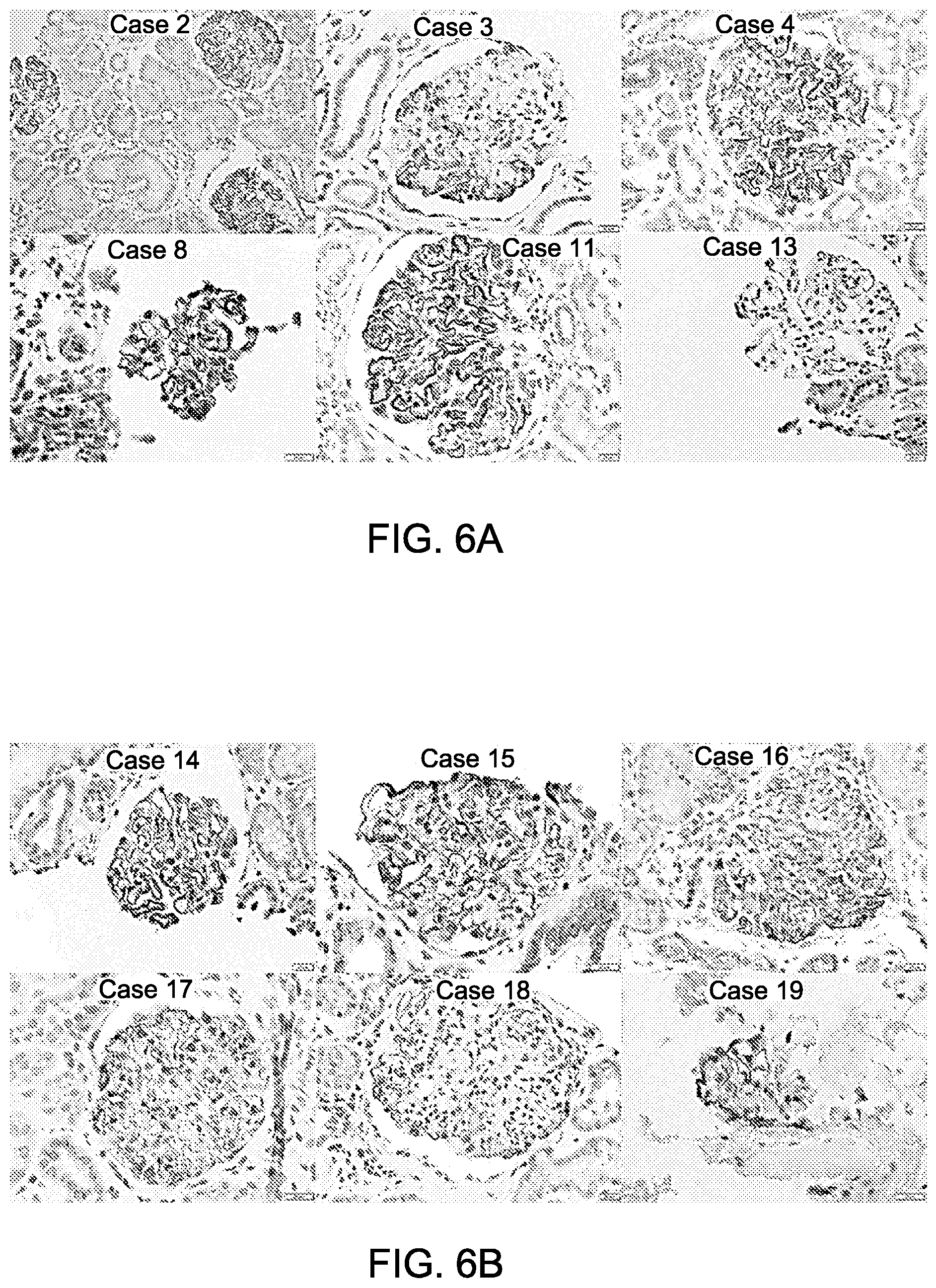 Patent US12612464 Figure 9 – Autoantibody specifically binding to NELL-1 and elevated NELL-1 polypeptide levels for identifying and treating membranous nephropathy