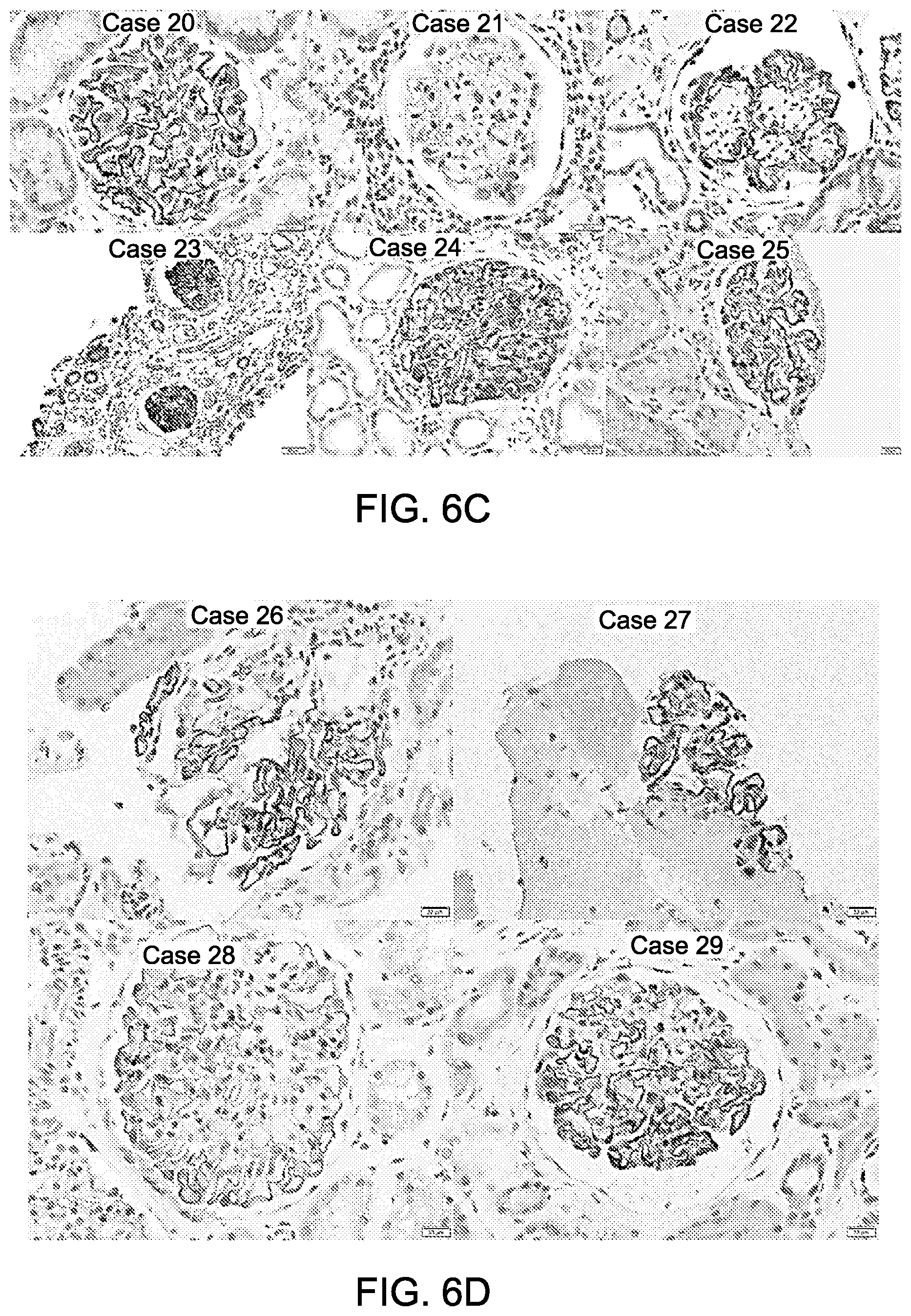 Patent US12612464 Figure 10 – Autoantibody specifically binding to NELL-1 and elevated NELL-1 polypeptide levels for identifying and treating membranous nephropathy