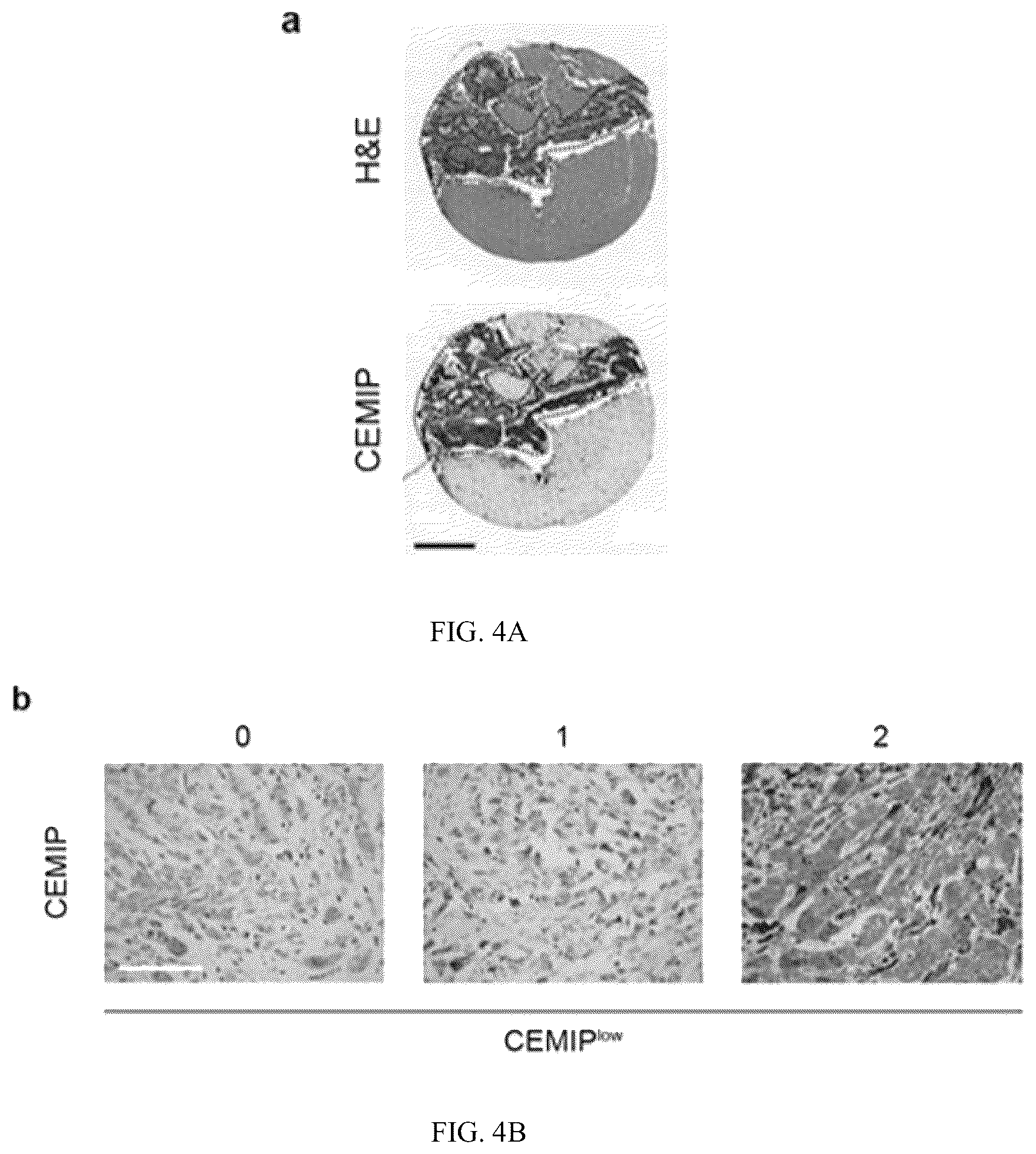 Patent US12613245 Figure 12 – Methods for detecting and inhibiting brain metastasis