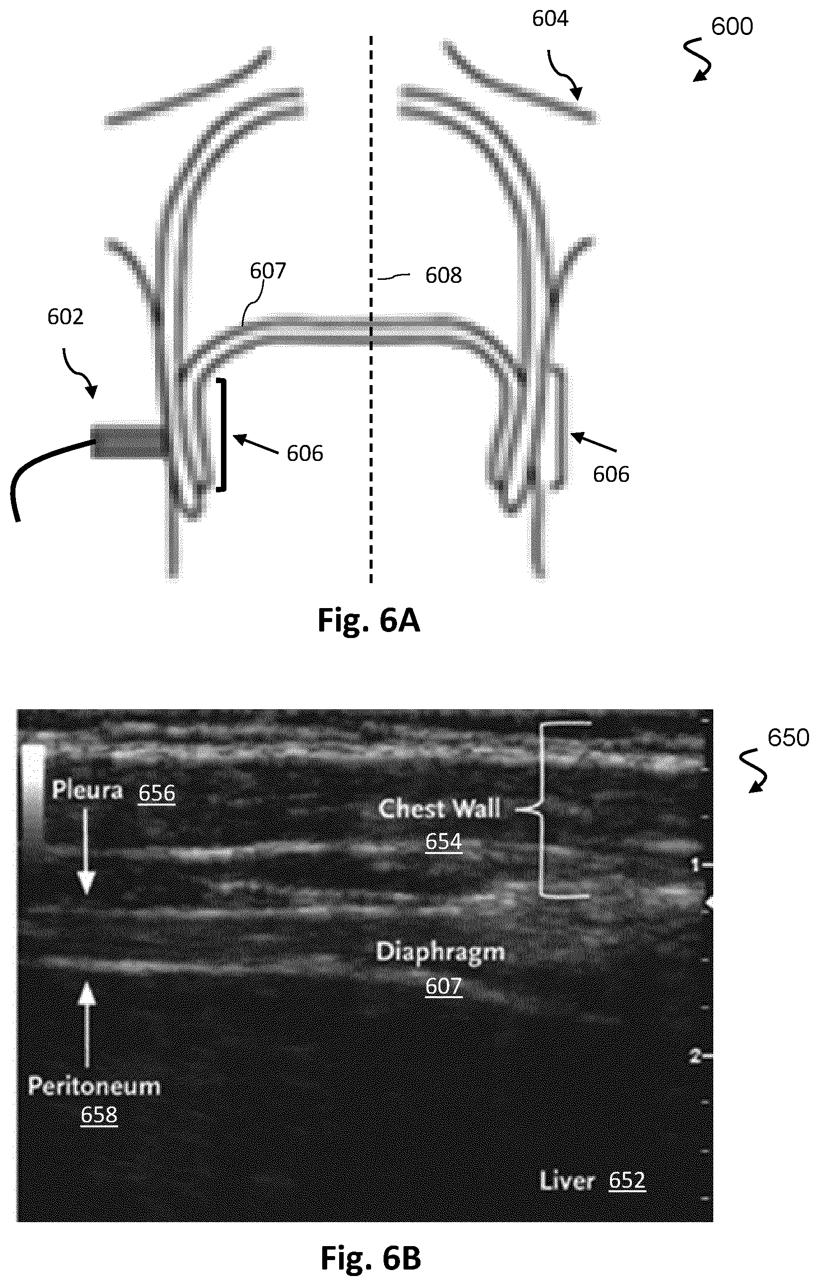 Patent US12613336 Figure 6 – Ultrasound imaging with anatomy-based acoustic settings