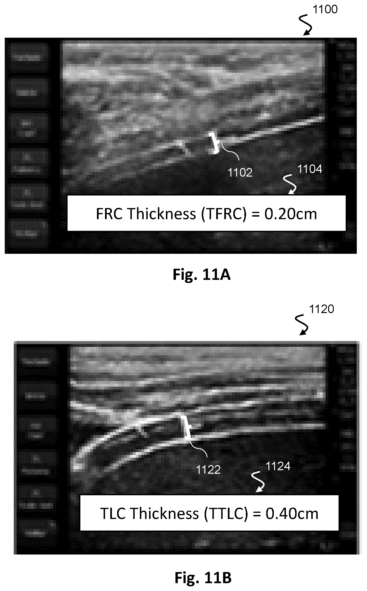 Patent US12613336 Figure 11 – Ultrasound imaging with anatomy-based acoustic settings