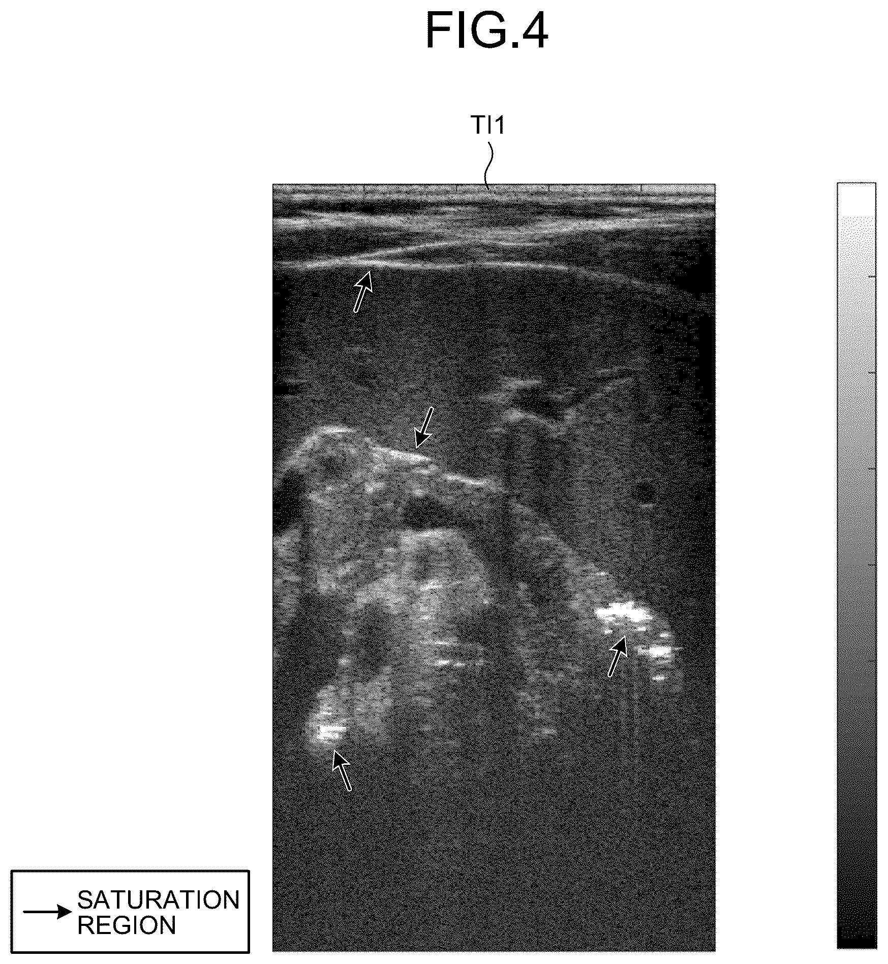 Patent US12613337 Figure 4 – Ultrasound diagnosis apparatus to correct a saturation region in an ultrasound image