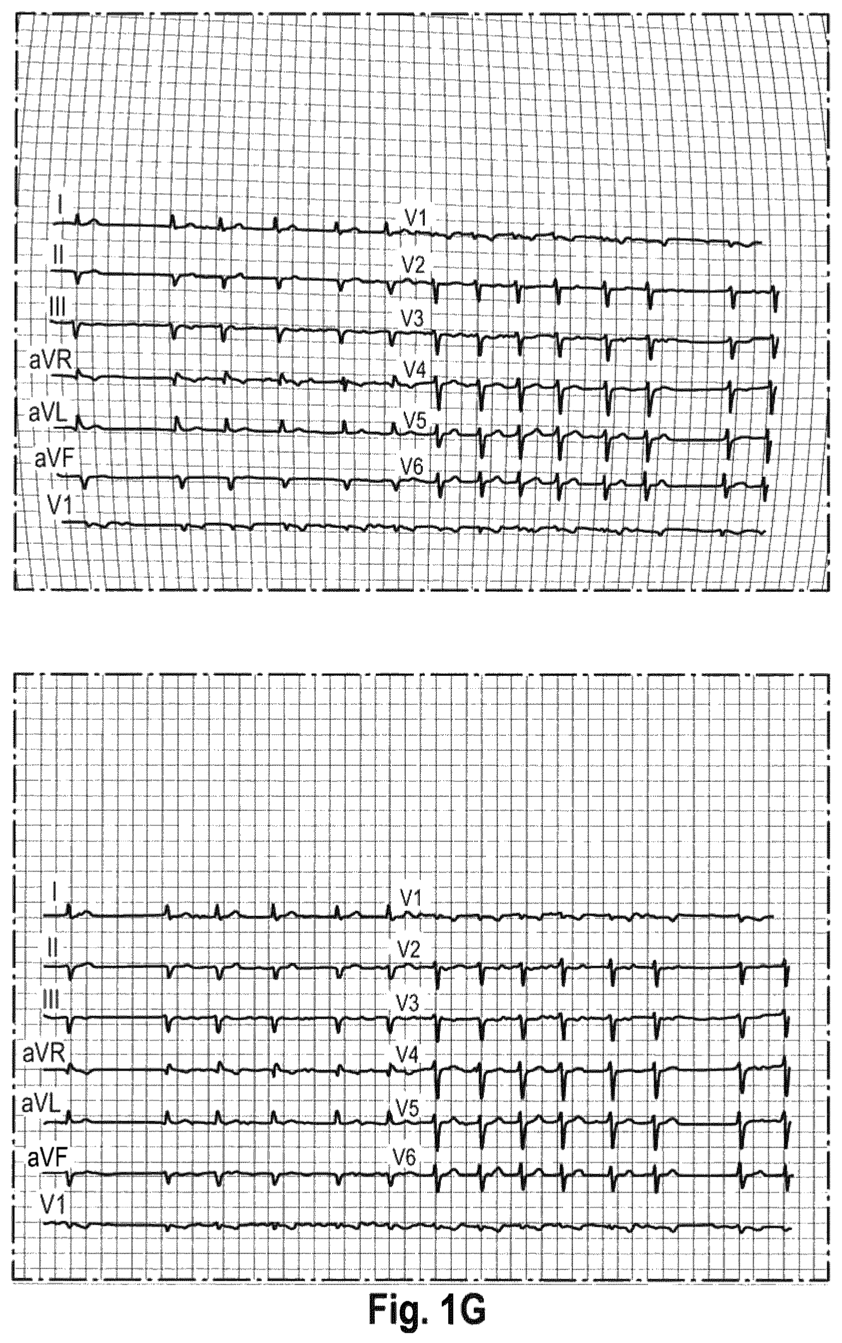 Patent US12614244 Figure 4 – Methods for generating an undistorted image from a distorted original image of a graphical representation