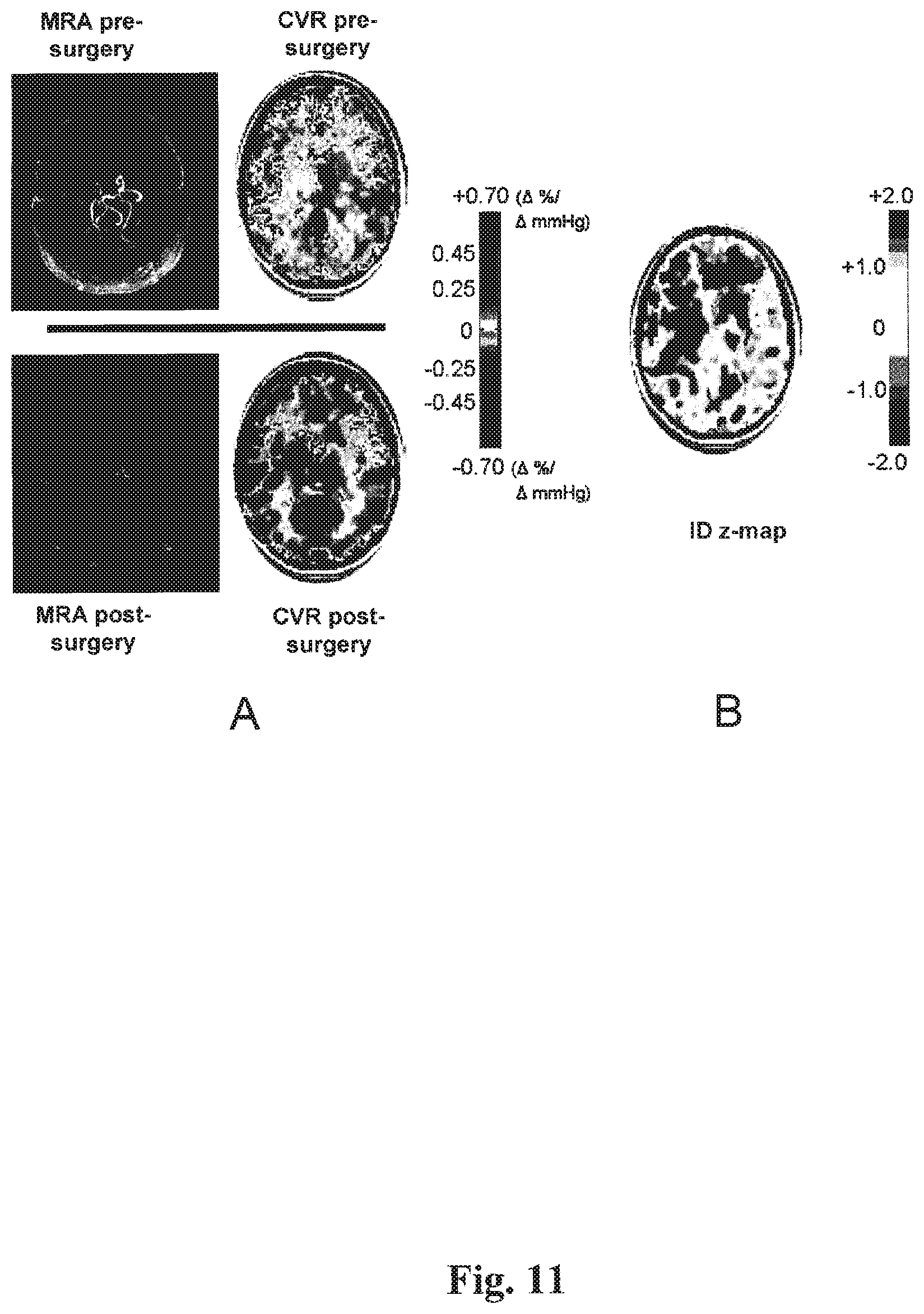 Patent US12614292 Figure 11 – Imaging abnormalities in vascular response