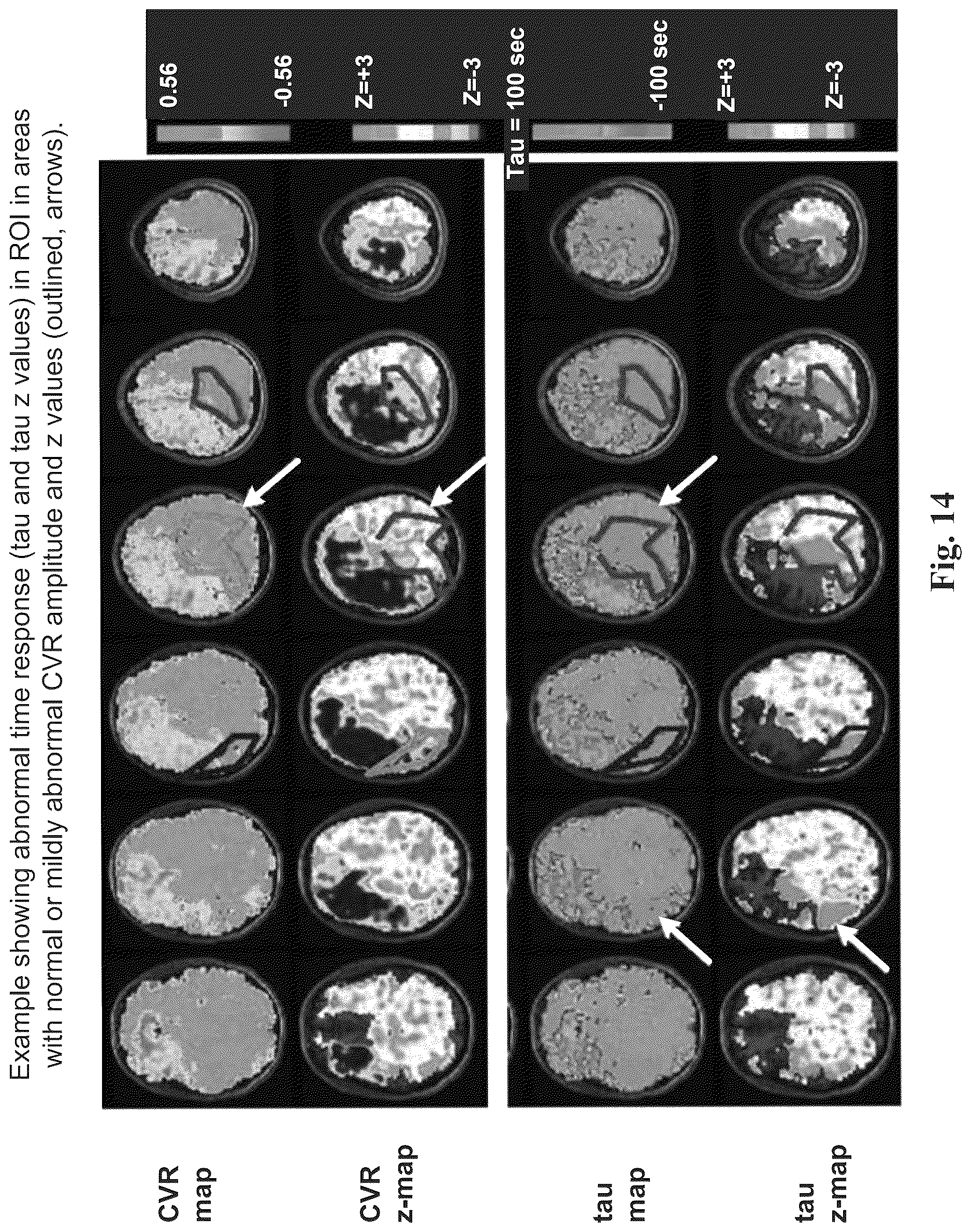 Patent US12614292 Figure 14 – Imaging abnormalities in vascular response