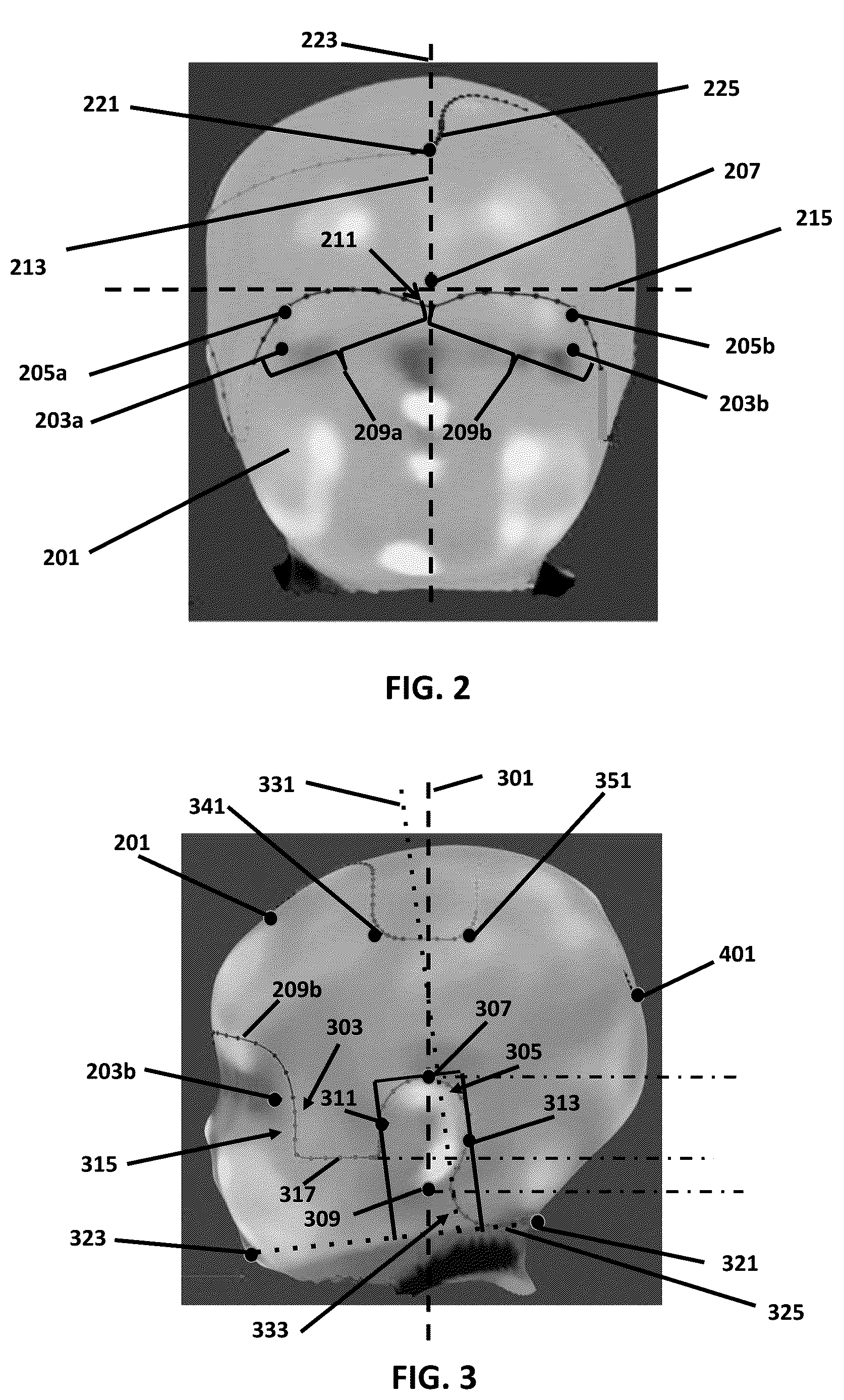 Patent US12614362 Figure 2 – Custom cranial remodeling devices manufactured by additive manufacture