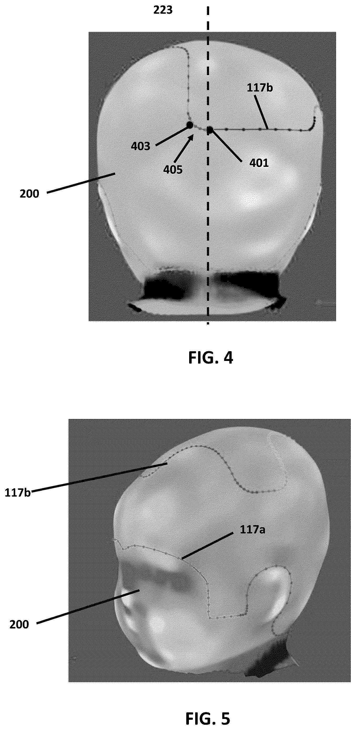 Patent US12614362 Figure 3 – Custom cranial remodeling devices manufactured by additive manufacture