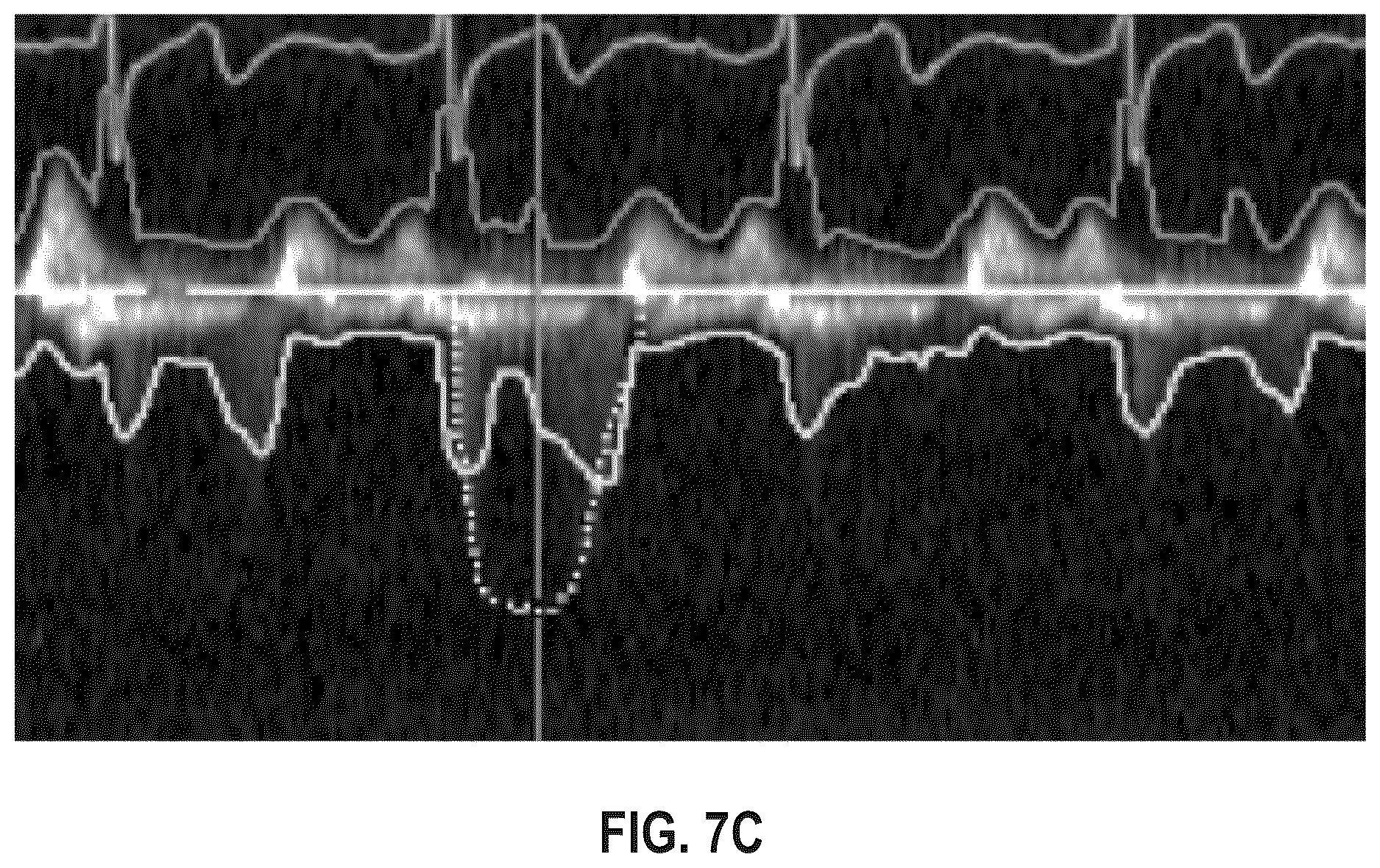 Patent US12614616 Figure 12 – Workflow for automatic measurement of doppler pipeline