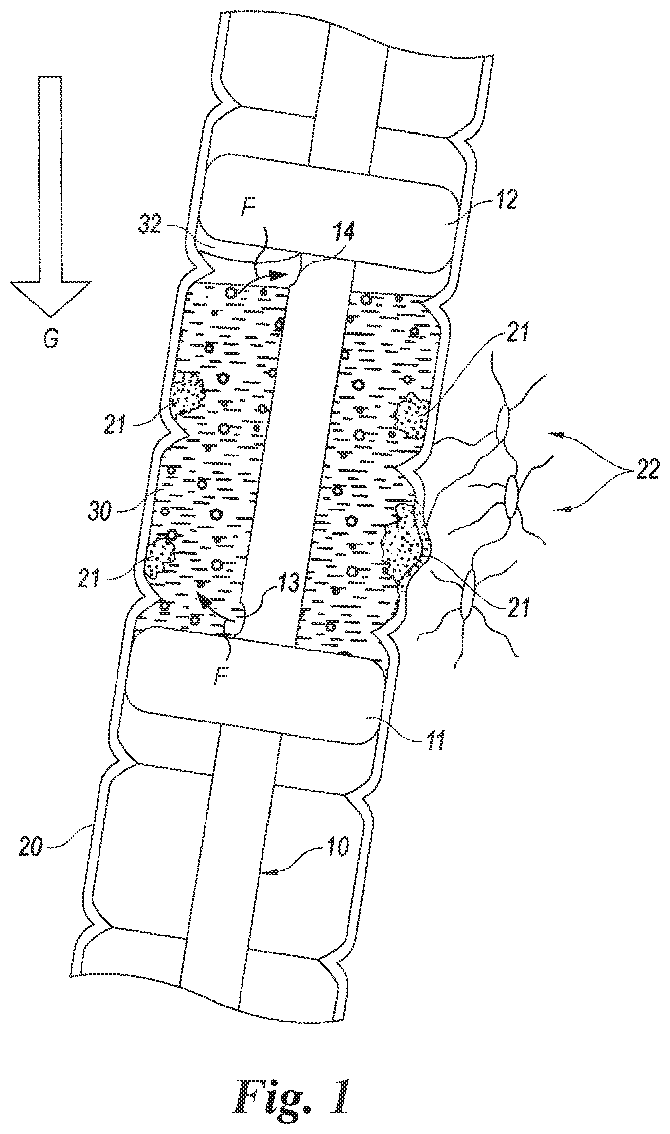 Patent US12614623 Figure 1 – Planning and navigation in superselective drug delivery via the tracheobronchial airway