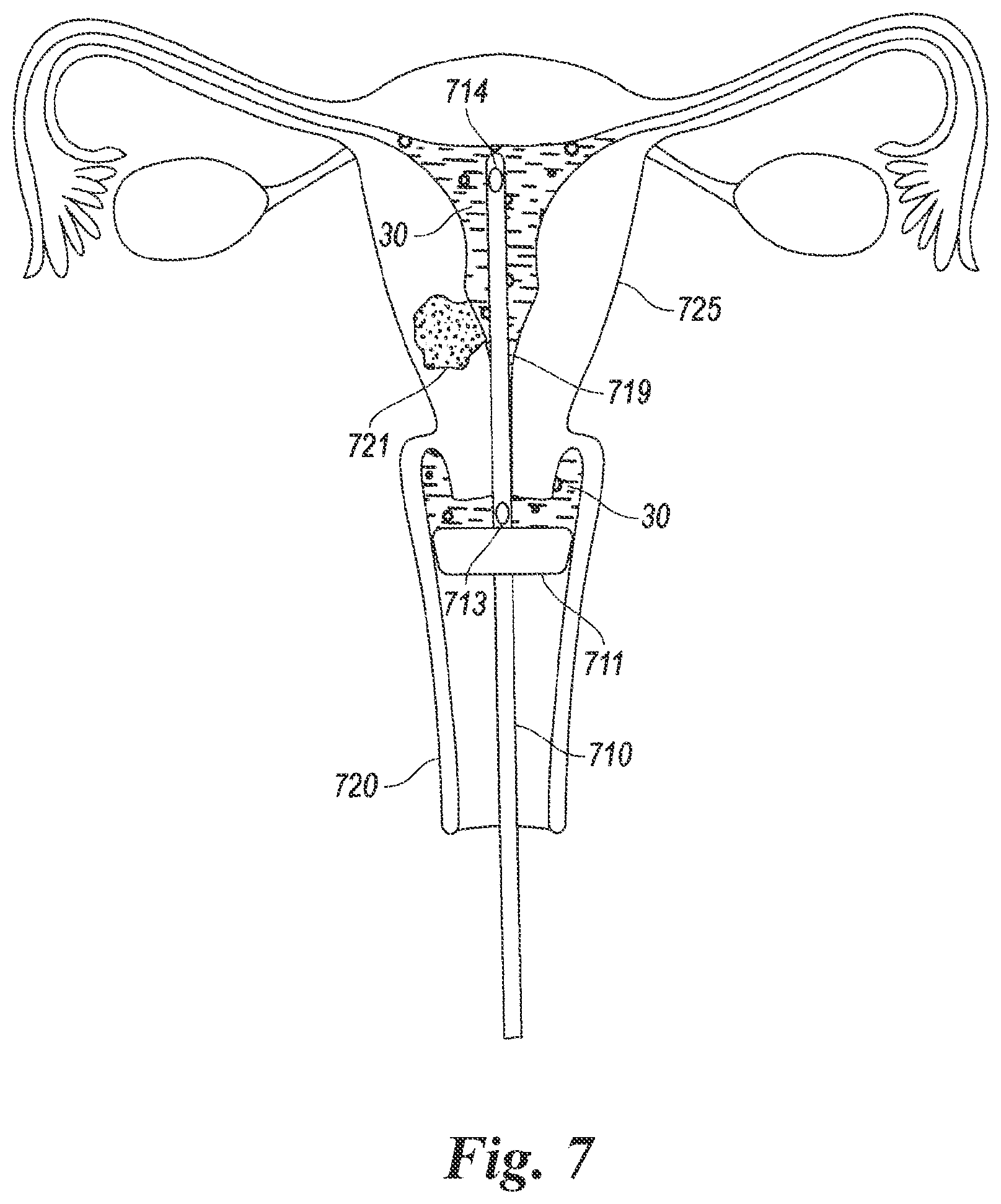 Patent US12614623 Figure 5 – Planning and navigation in superselective drug delivery via the tracheobronchial airway