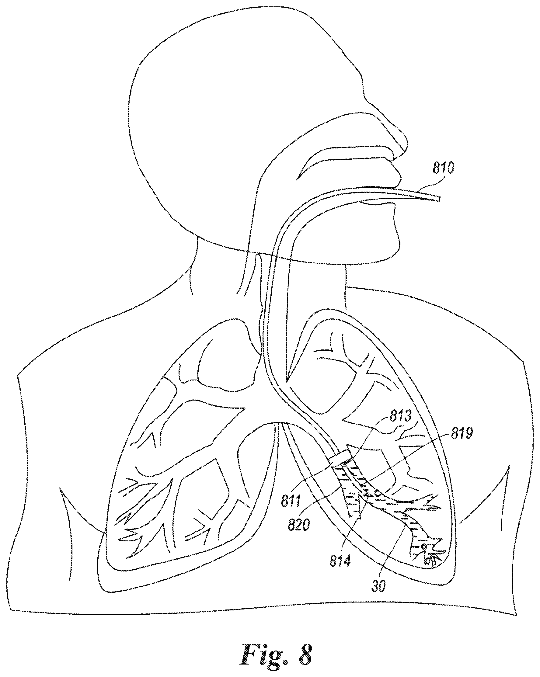 Patent US12614623 Figure 6 – Planning and navigation in superselective drug delivery via the tracheobronchial airway