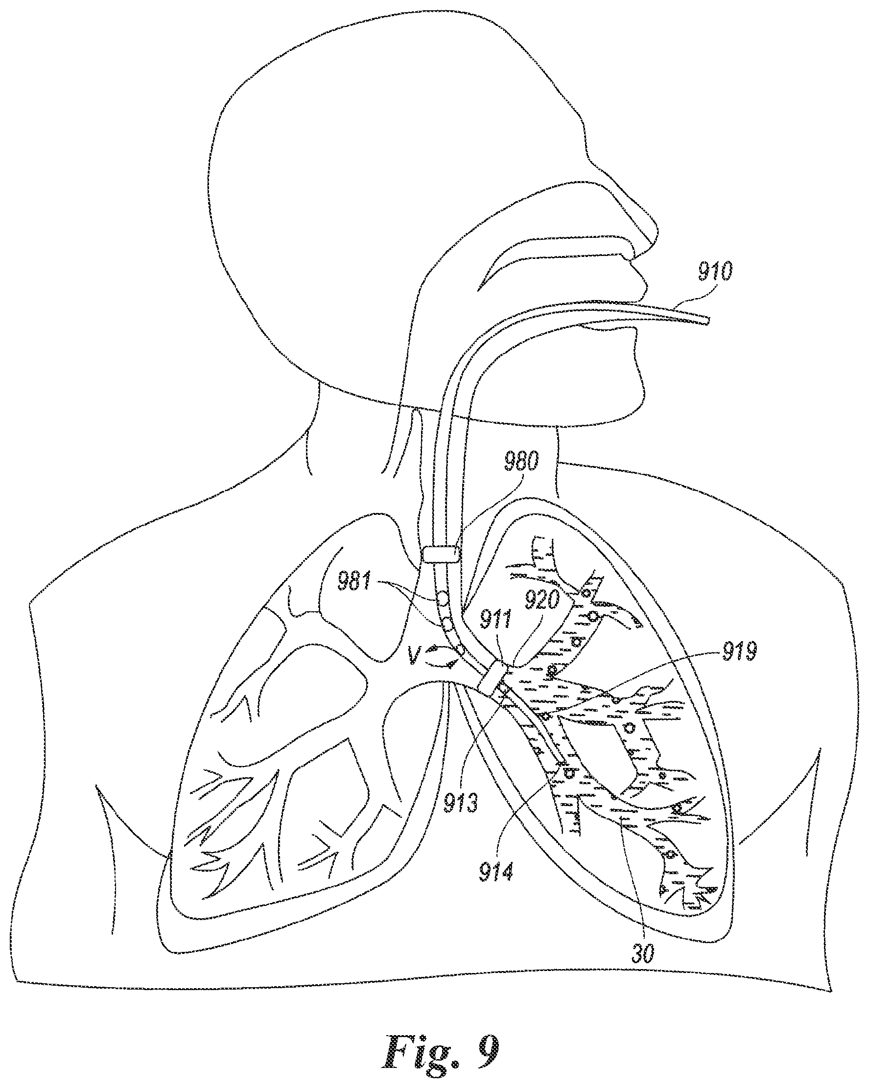 Patent US12614623 Figure 7 – Planning and navigation in superselective drug delivery via the tracheobronchial airway