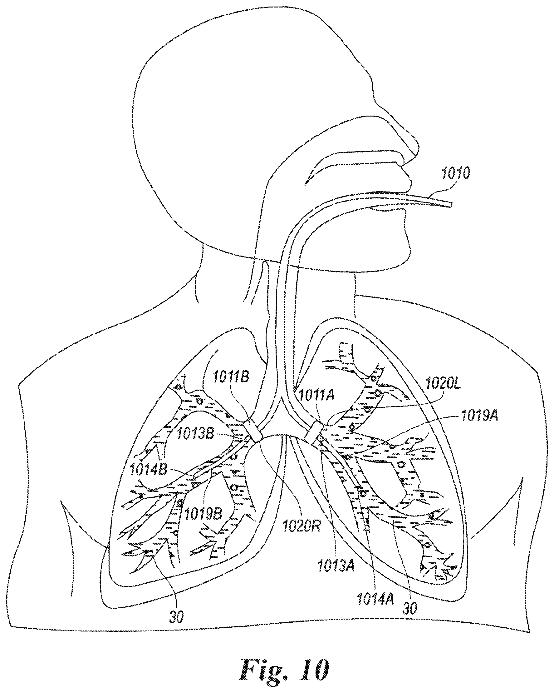Patent US12614623 Figure 8 – Planning and navigation in superselective drug delivery via the tracheobronchial airway