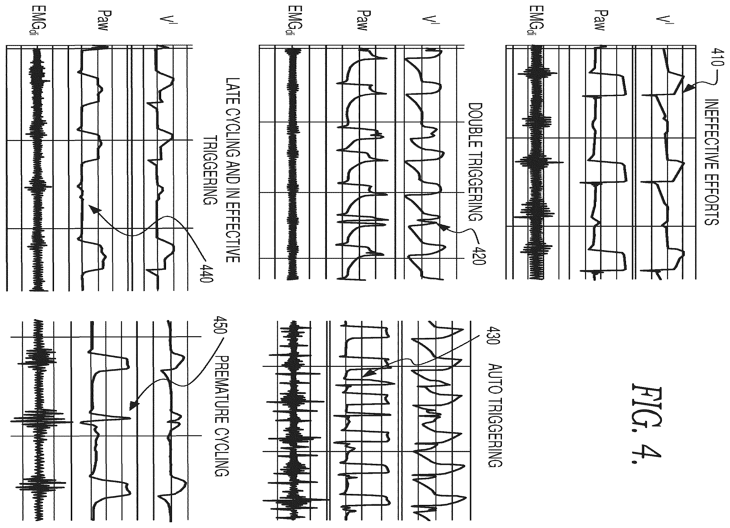 Patent US12614636 Figure 5 – Patient ventilator asynchrony detection