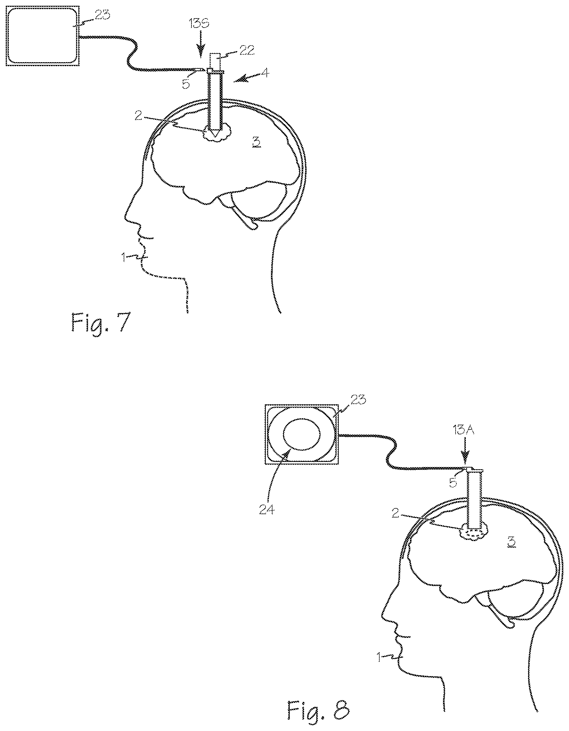 Patent US12616359 Figure 3 – Cannula and obturator with a transparent tip with an opaque component