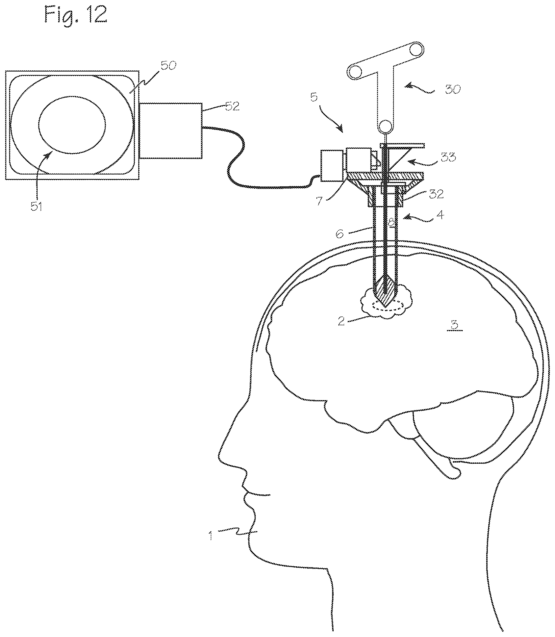 Patent US12616359 Figure 5 – Cannula and obturator with a transparent tip with an opaque component