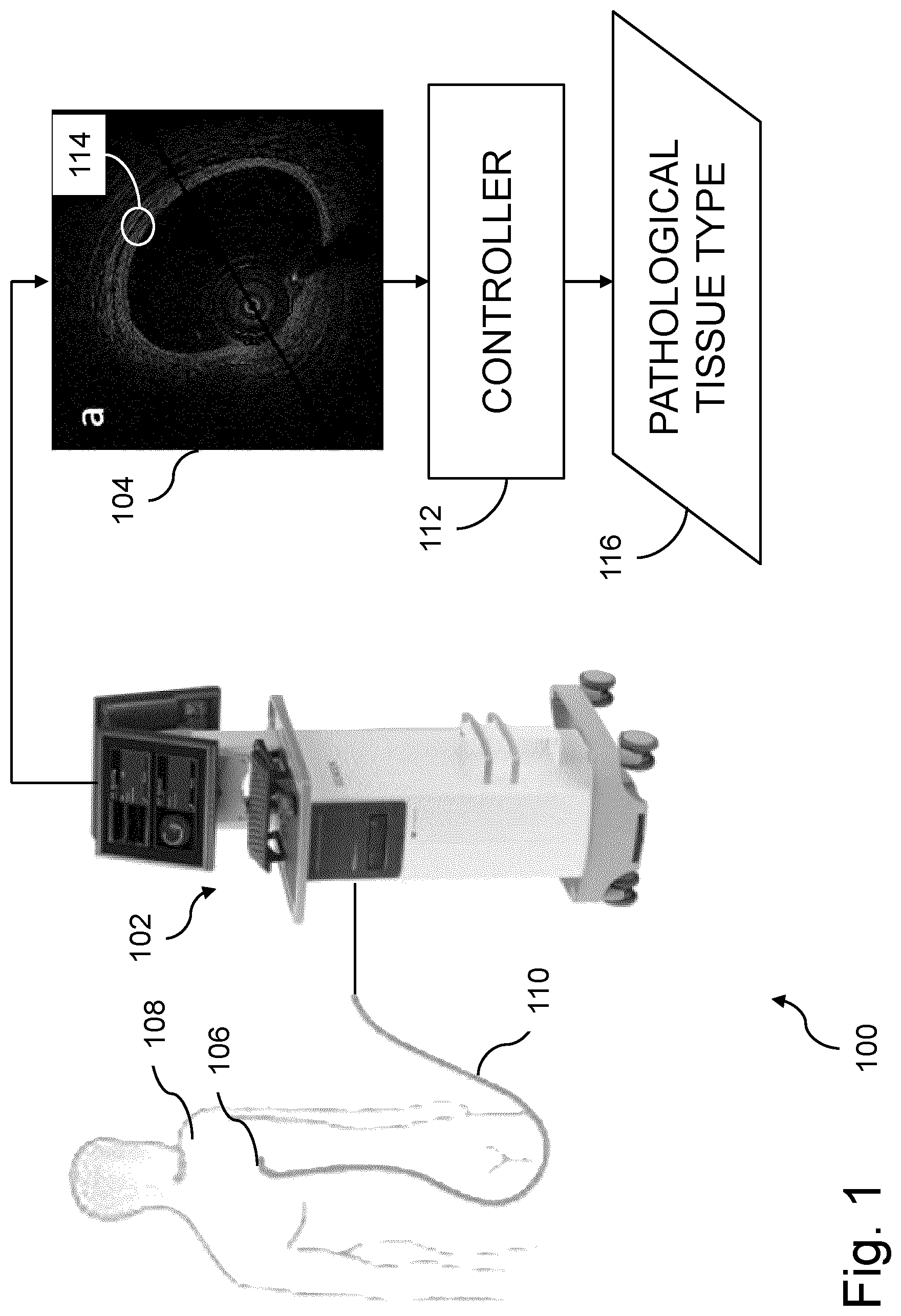 Patent US12616370 Figure 1 – System and method for determining atherosclerotic pathological tissue types in a coronary artery OCT image using trained engines