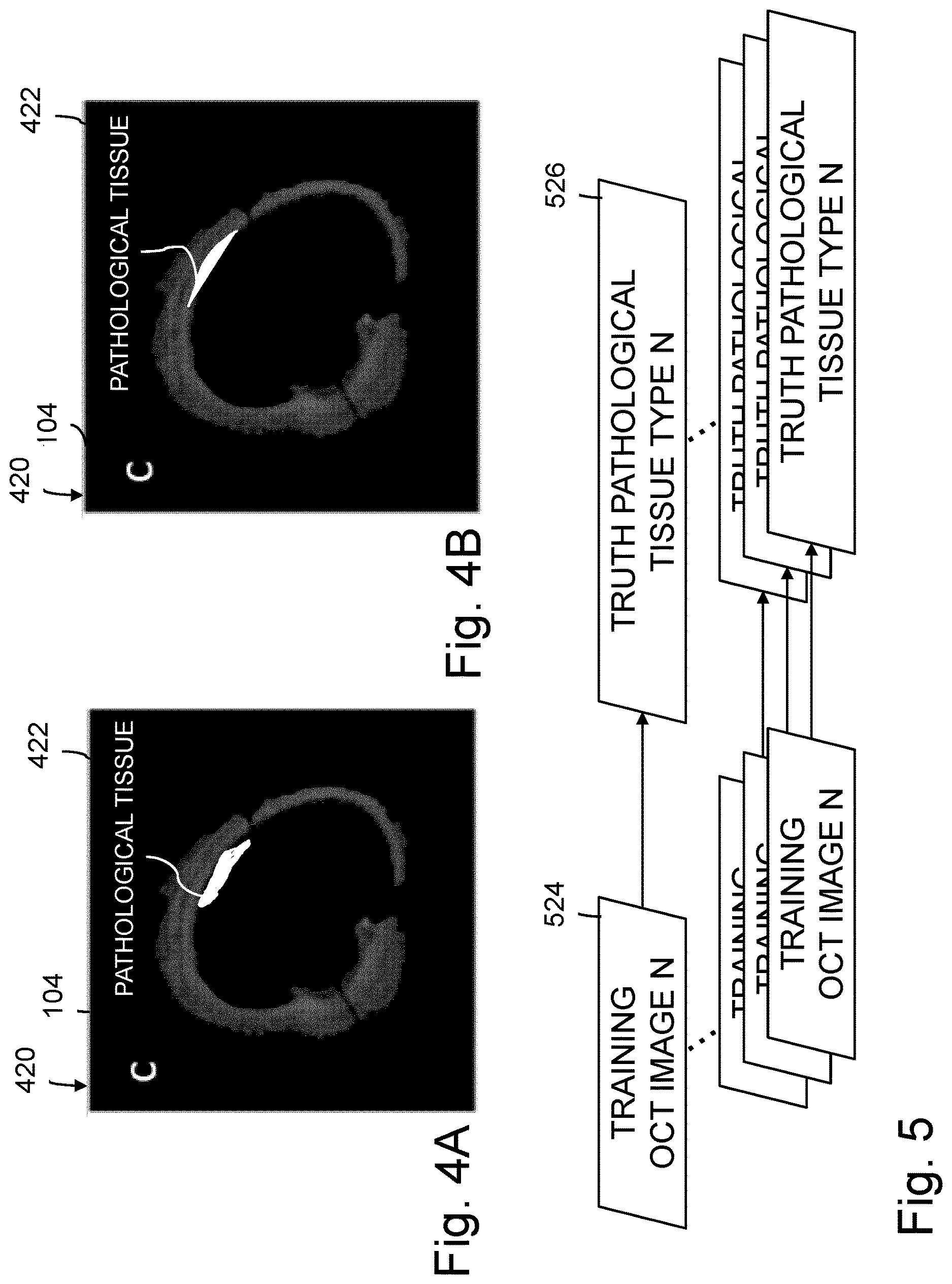 Patent US12616370 Figure 4 – System and method for determining atherosclerotic pathological tissue types in a coronary artery OCT image using trained engines