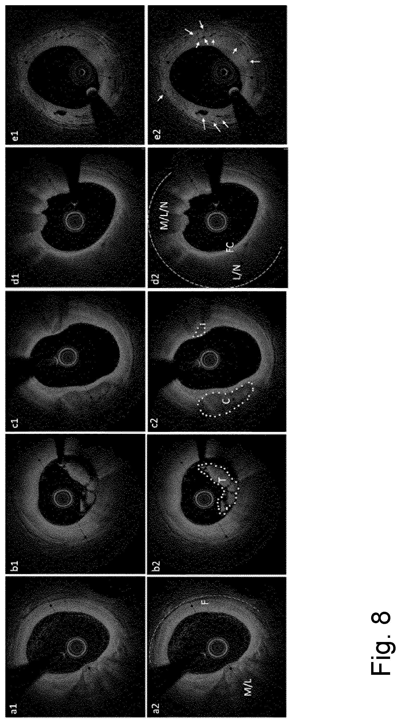 Patent US12616370 Figure 8 – System and method for determining atherosclerotic pathological tissue types in a coronary artery OCT image using trained engines