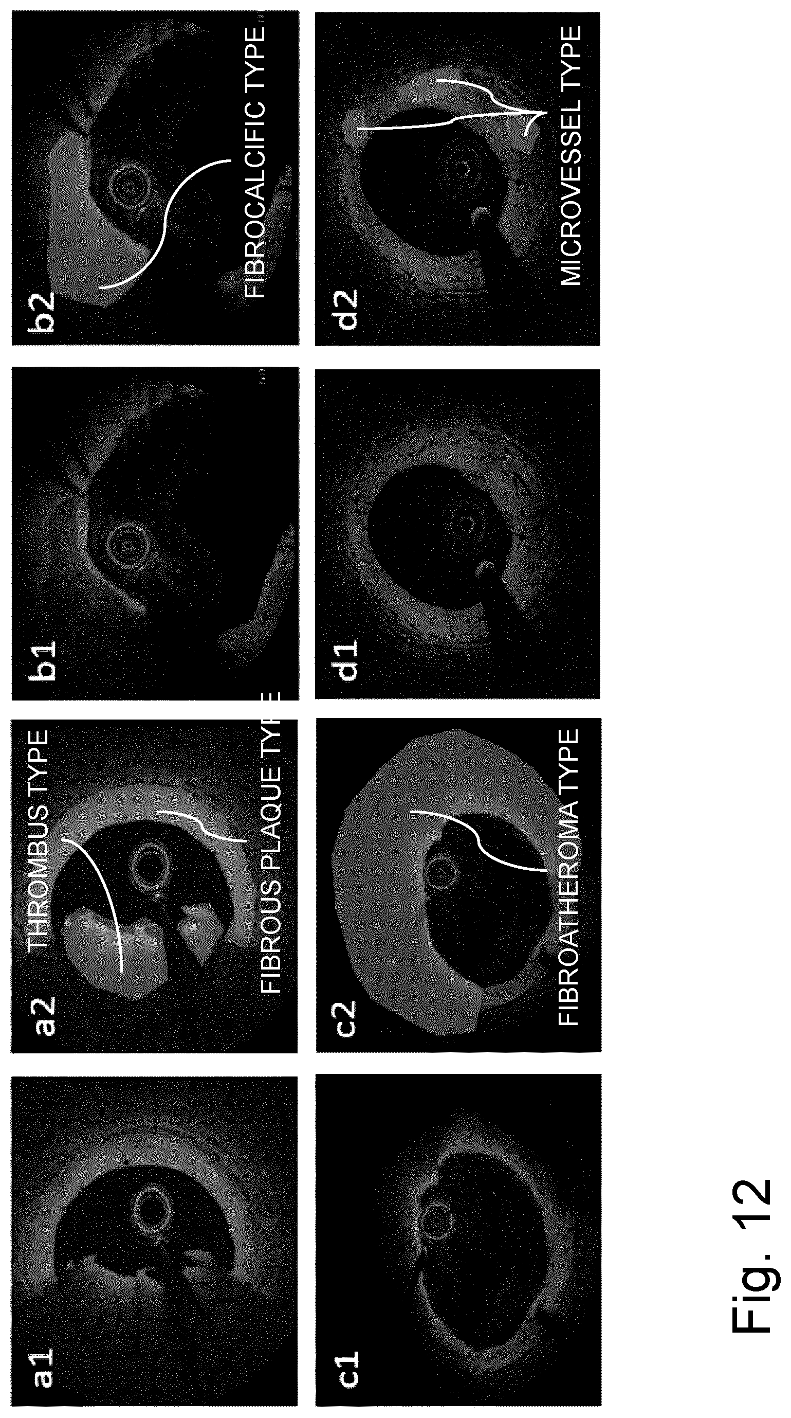 Patent US12616370 Figure 12 – System and method for determining atherosclerotic pathological tissue types in a coronary artery OCT image using trained engines