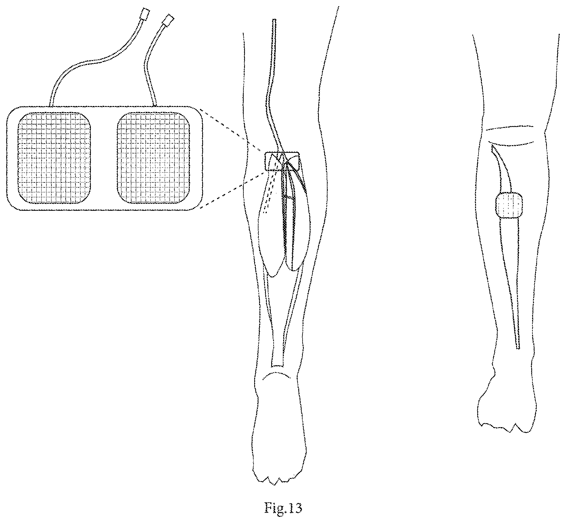 Patent US12616381 Figure 12 – System for management and prevention of venous pooling