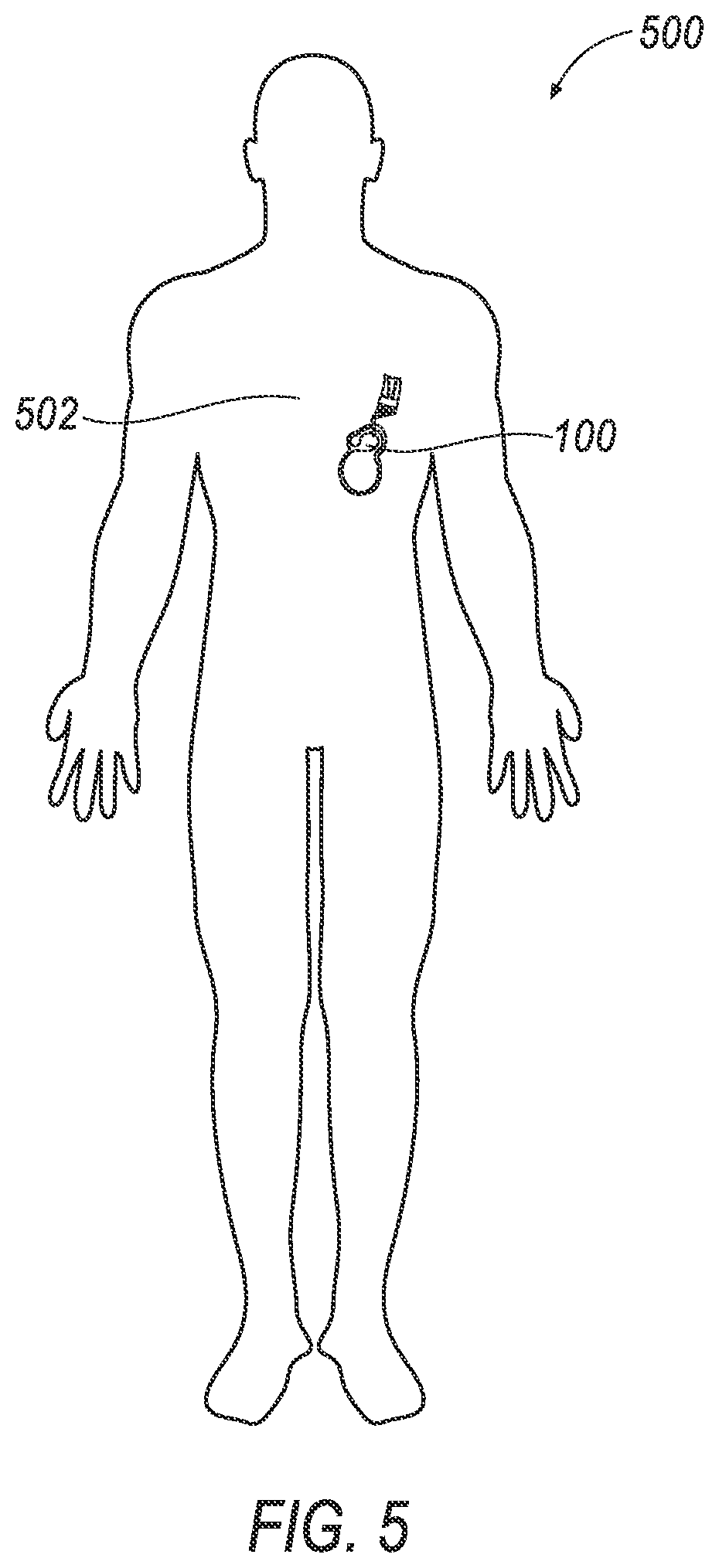 Patent US12616382 Figure 5 – Wearable mechano-acoustic sensor