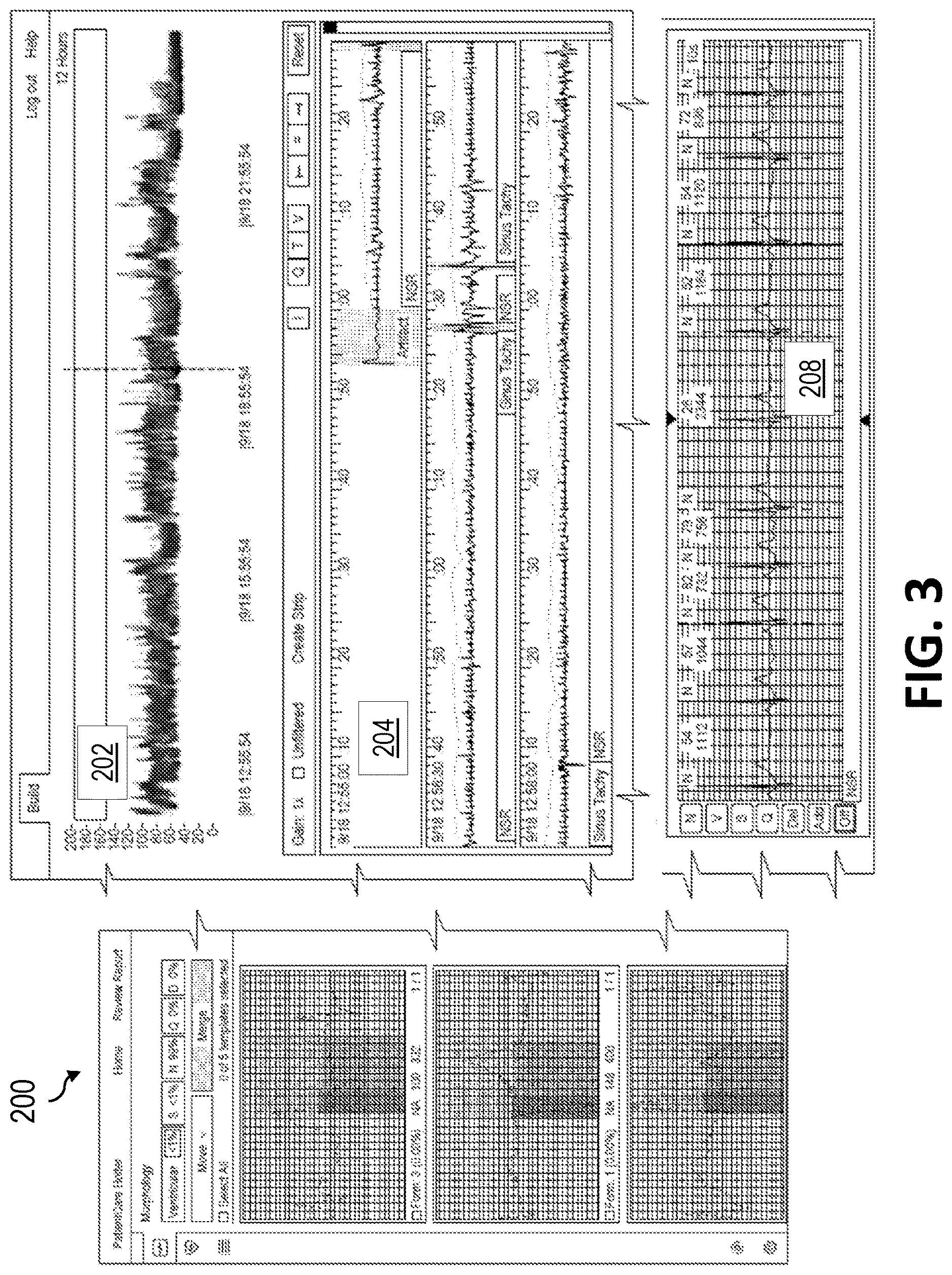 Patent US12616411 Figure 3 – Overriding longest RR intervals