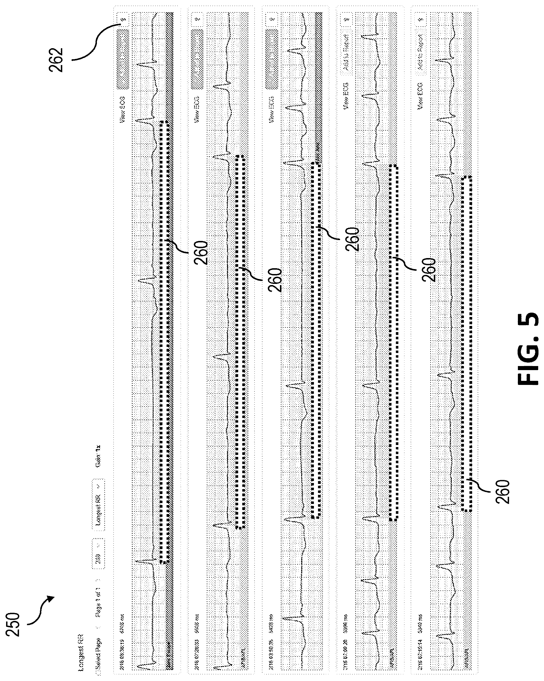Patent US12616411 Figure 5 – Overriding longest RR intervals