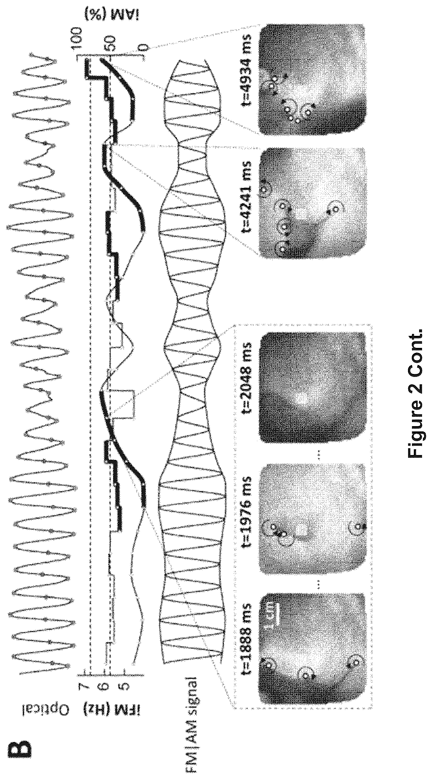 Patent US12616412 Figure 4 – Method for the identification of cardiac fibrillation drivers and/or the footprint of rotational activations using single optical or electrical signals without requiring panoramic simultaneous acquisition