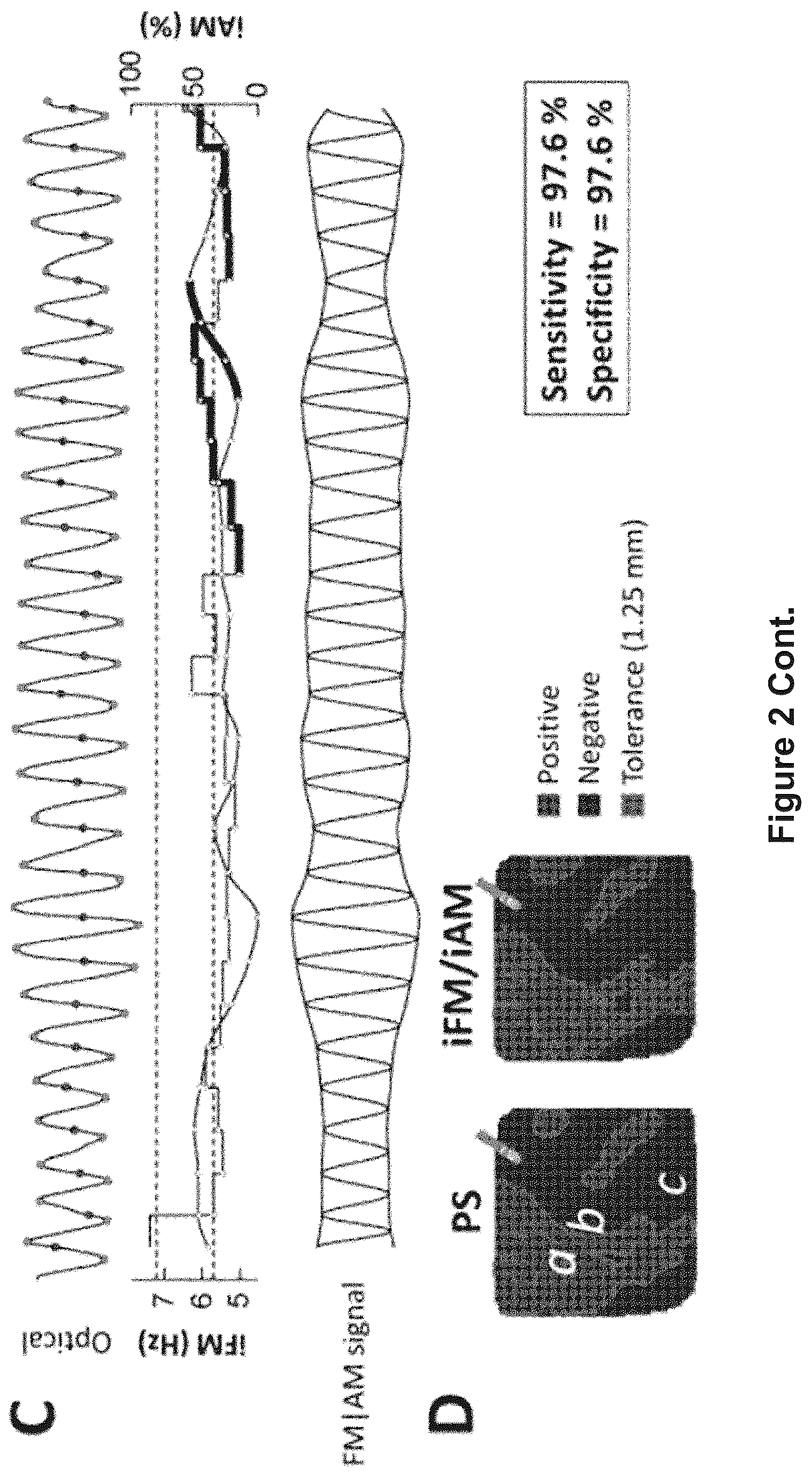 Patent US12616412 Figure 5 – Method for the identification of cardiac fibrillation drivers and/or the footprint of rotational activations using single optical or electrical signals without requiring panoramic simultaneous acquisition