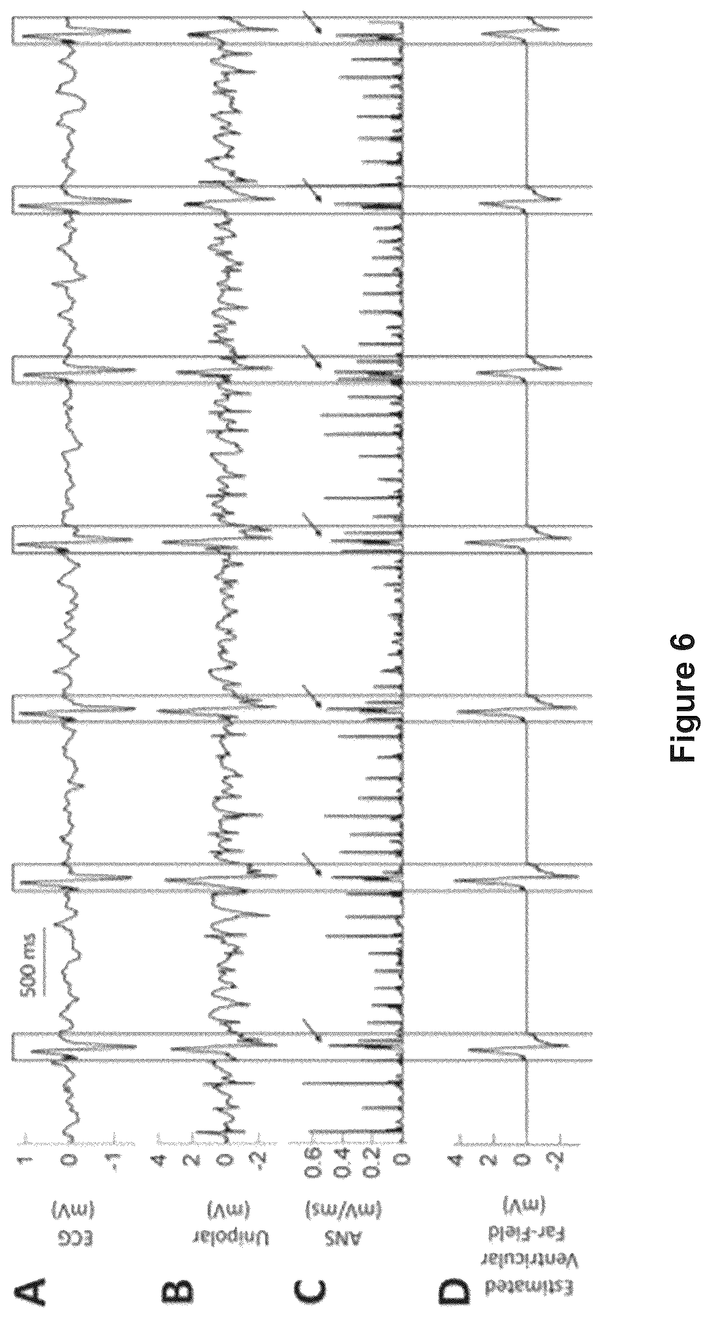 Patent US12616412 Figure 14 – Method for the identification of cardiac fibrillation drivers and/or the footprint of rotational activations using single optical or electrical signals without requiring panoramic simultaneous acquisition