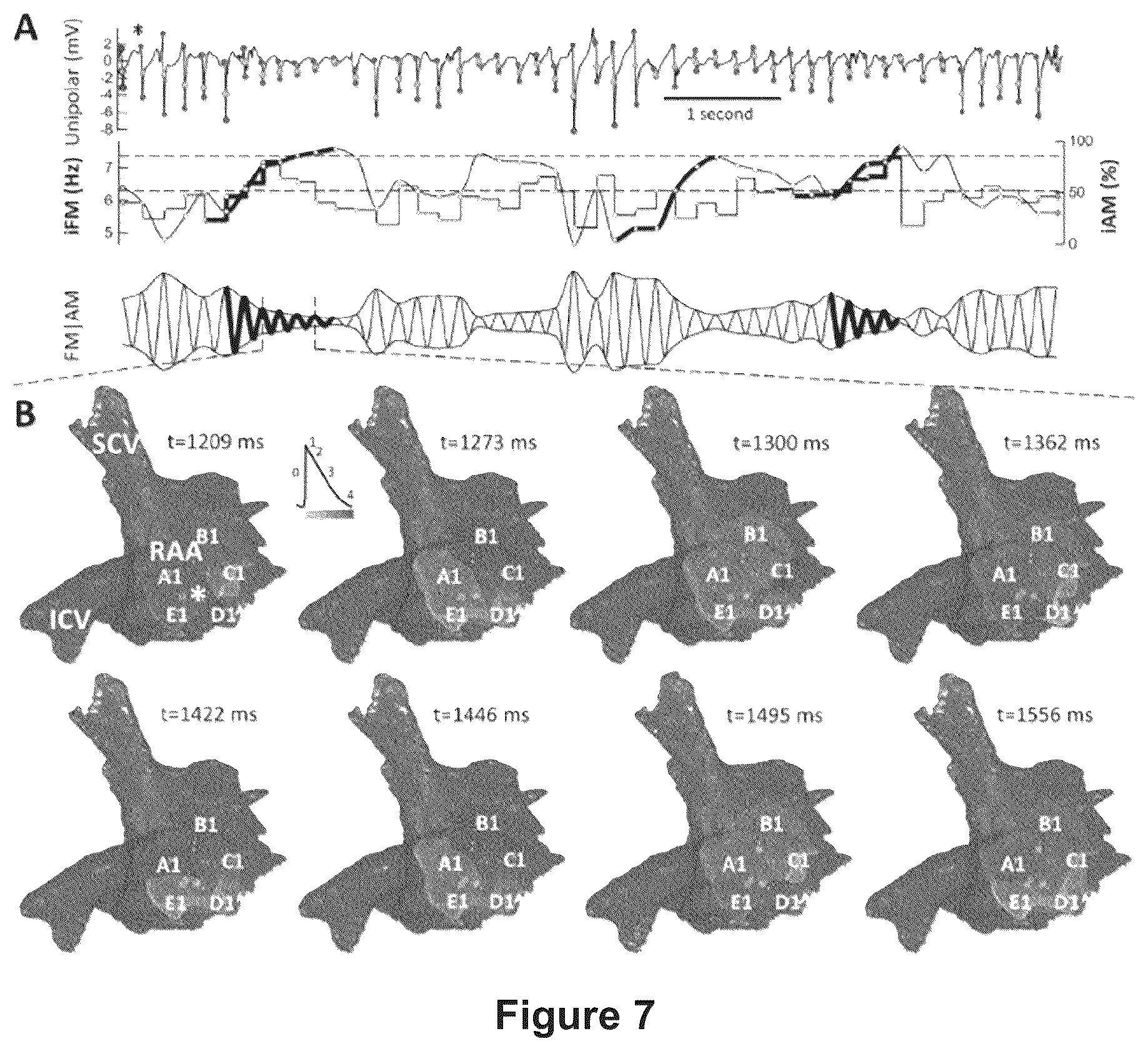 Patent US12616412 Figure 16 – Method for the identification of cardiac fibrillation drivers and/or the footprint of rotational activations using single optical or electrical signals without requiring panoramic simultaneous acquisition