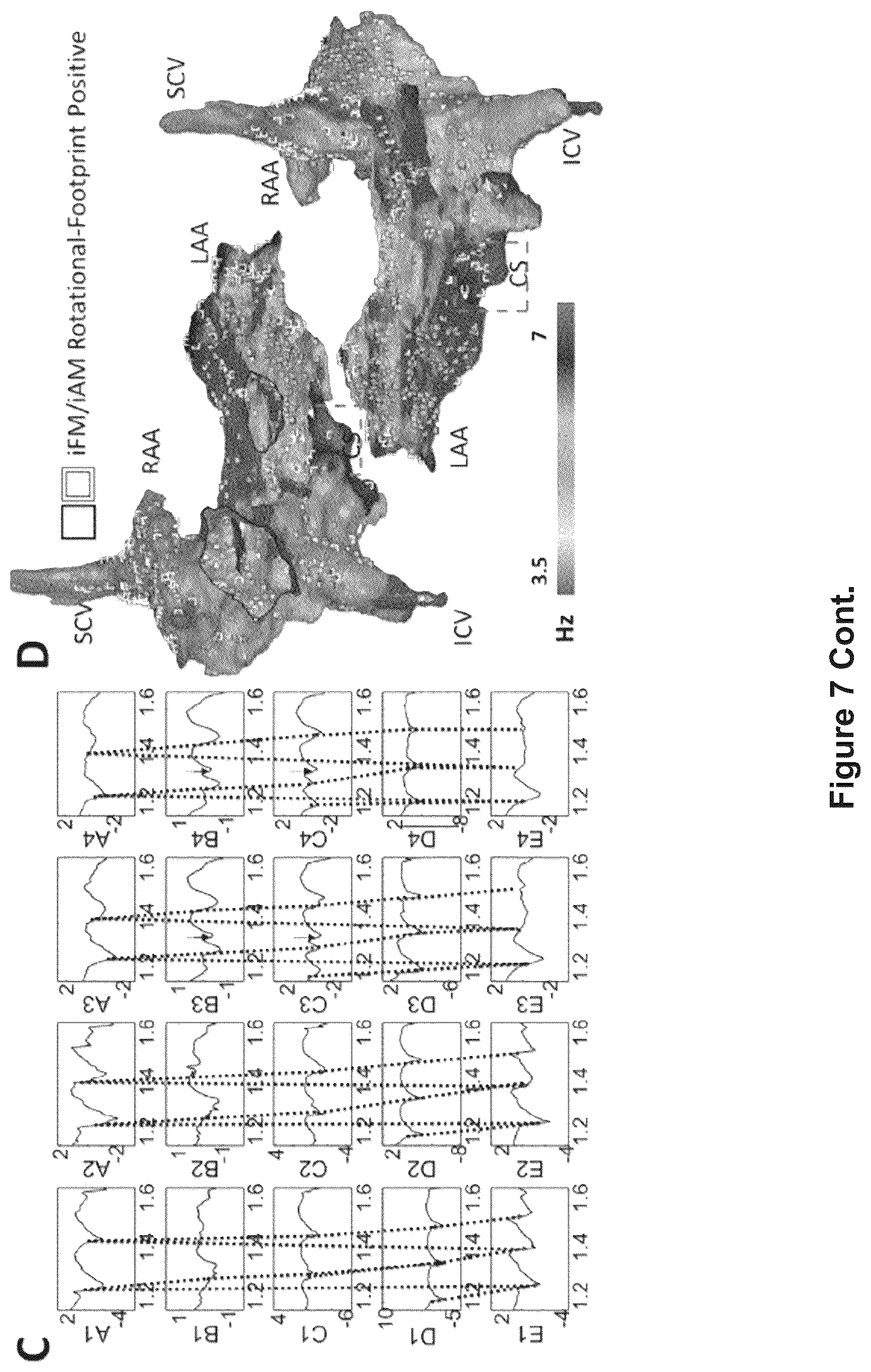 Patent US12616412 Figure 17 – Method for the identification of cardiac fibrillation drivers and/or the footprint of rotational activations using single optical or electrical signals without requiring panoramic simultaneous acquisition