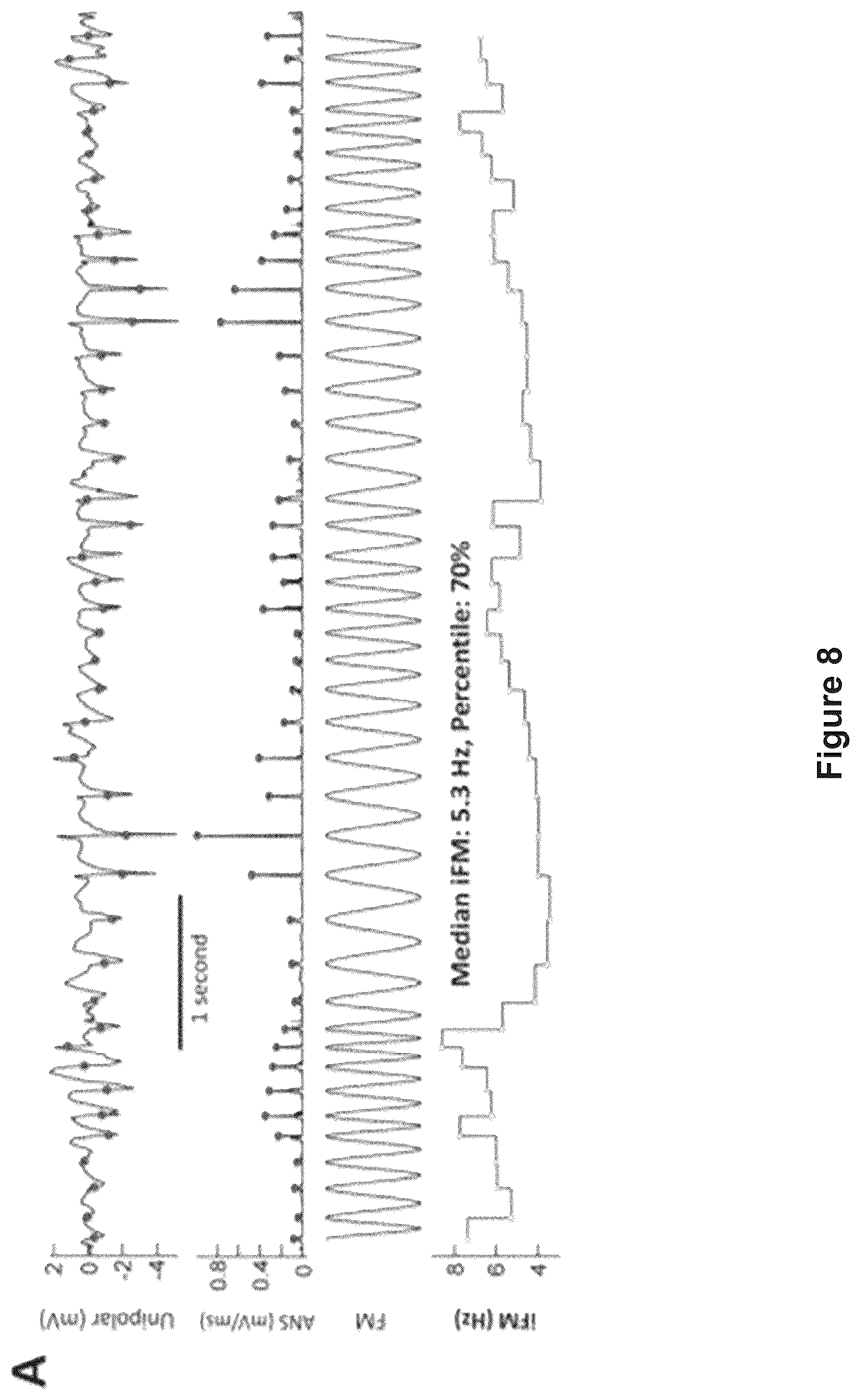 Patent US12616412 Figure 18 – Method for the identification of cardiac fibrillation drivers and/or the footprint of rotational activations using single optical or electrical signals without requiring panoramic simultaneous acquisition