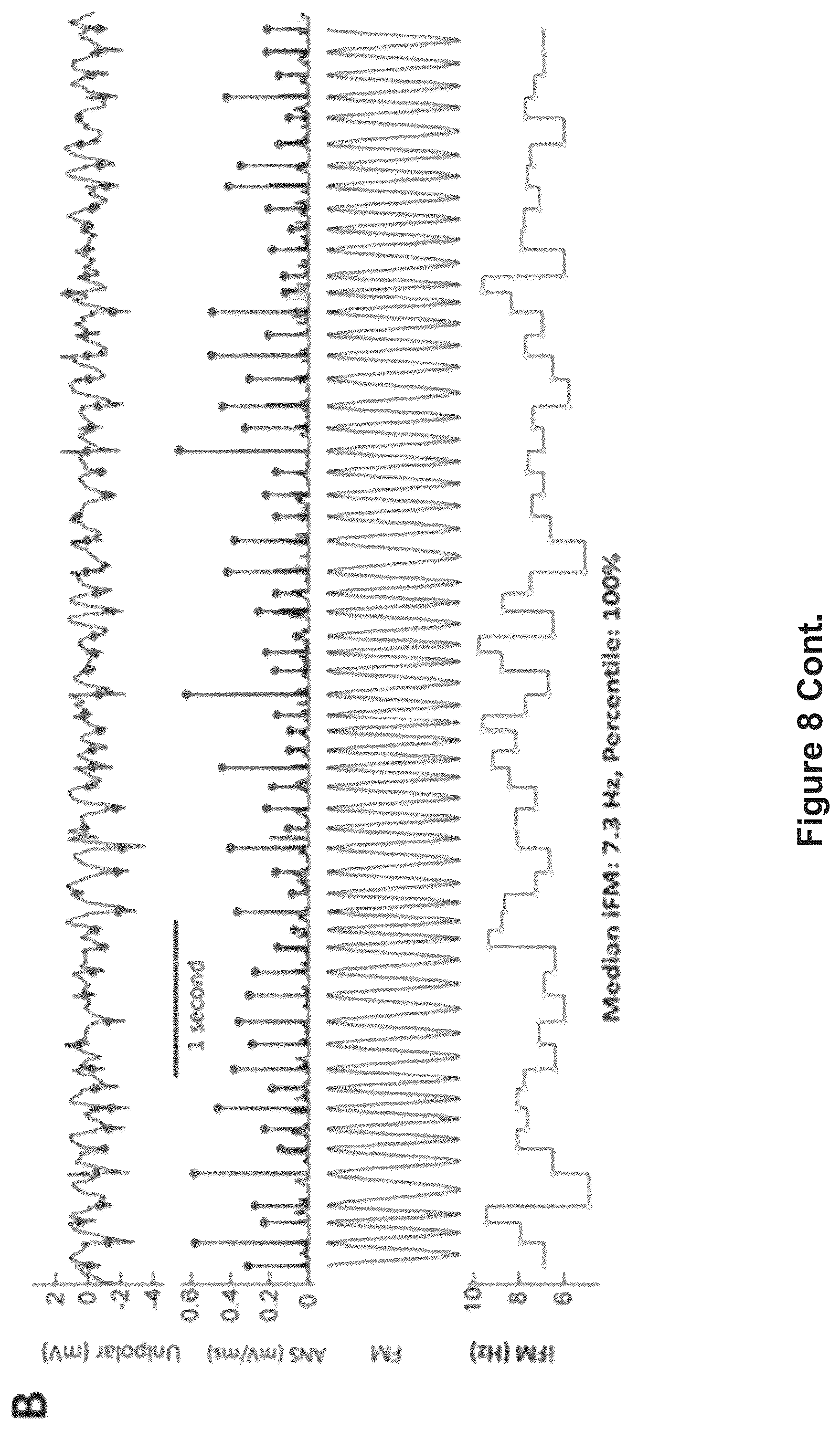 Patent US12616412 Figure 19 – Method for the identification of cardiac fibrillation drivers and/or the footprint of rotational activations using single optical or electrical signals without requiring panoramic simultaneous acquisition