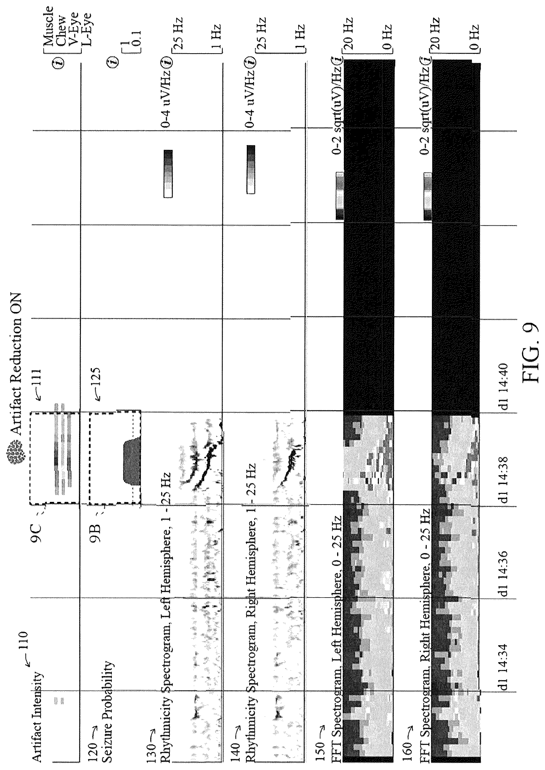 Patent US12616421 Figure 10 – System and method for generating a probability value for an epileptiform abnormality by neural network to identify signal spikes