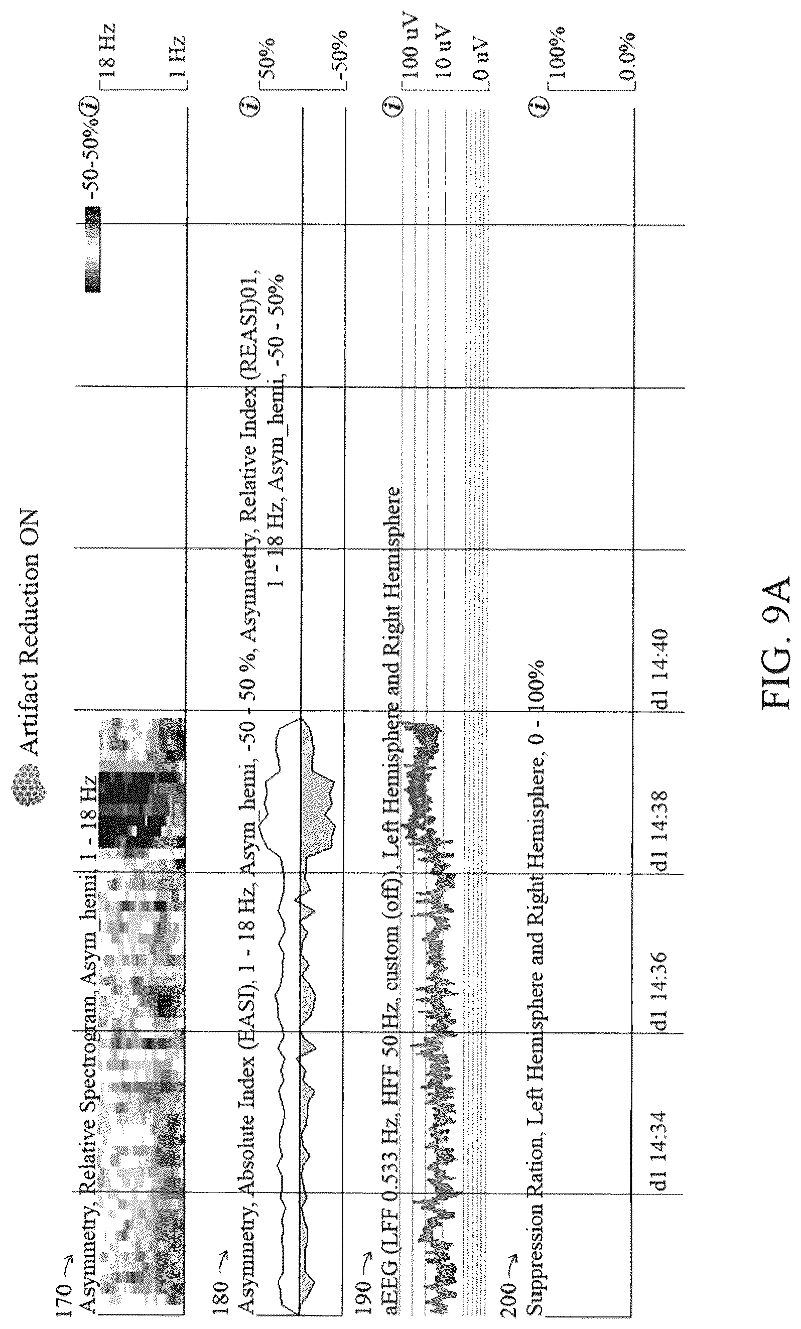 Patent US12616421 Figure 11 – System and method for generating a probability value for an epileptiform abnormality by neural network to identify signal spikes