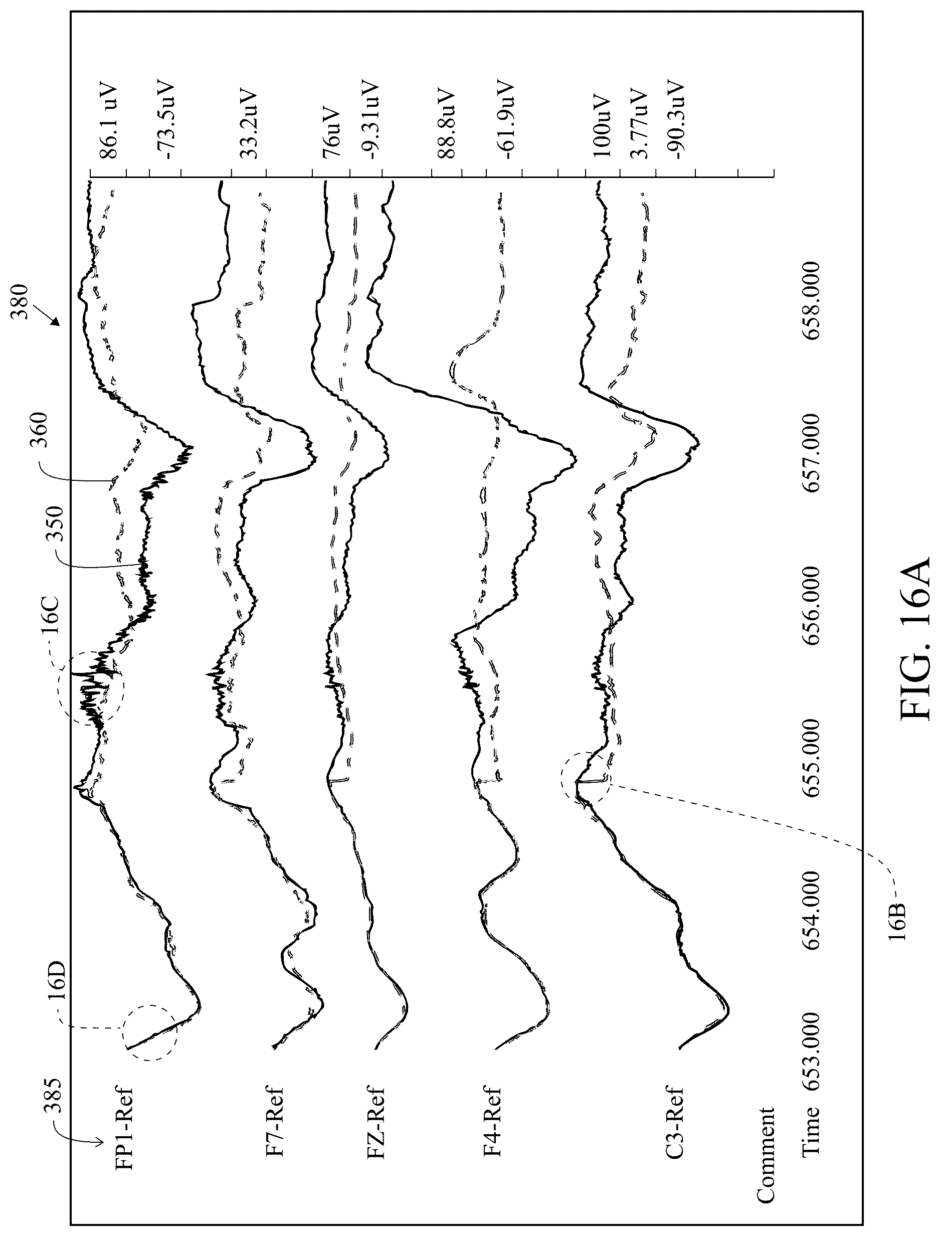 Patent US12616421 Figure 19 – System and method for generating a probability value for an epileptiform abnormality by neural network to identify signal spikes