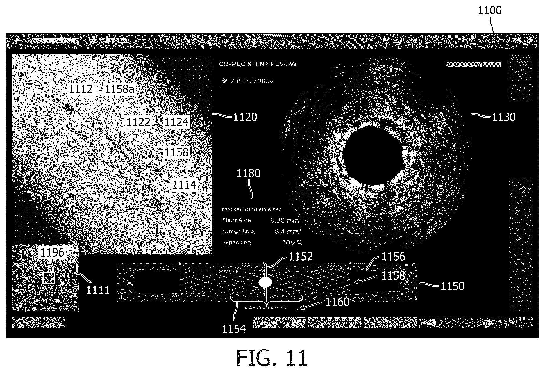 Patent US12616442 Figure 11 – Systems, devices, and methods for coregistration of intravascular data to enhanced stent deployment x-ray images
