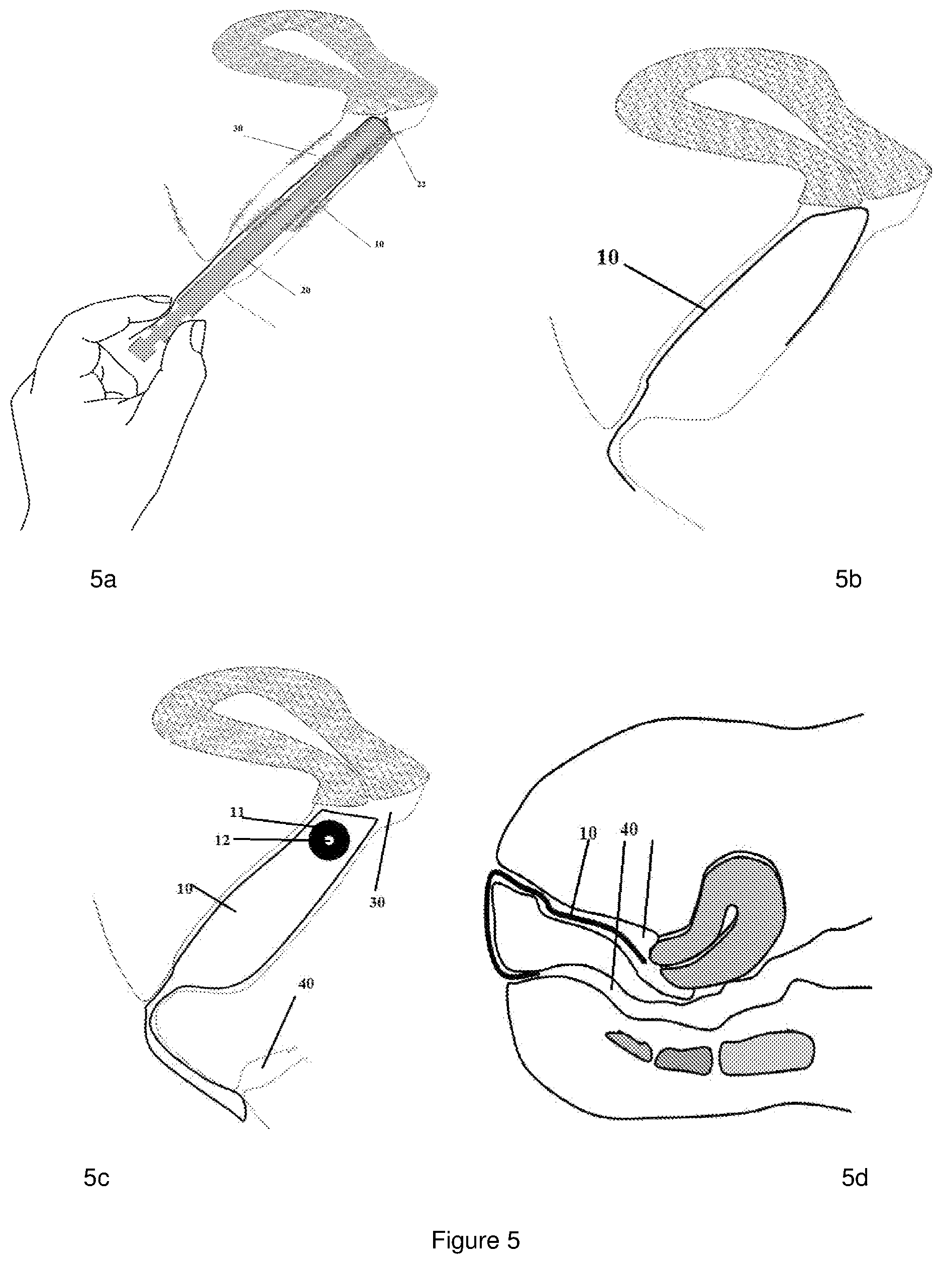 Patent US12616454 Figure 5 – Self sampling universal kit, methods and use