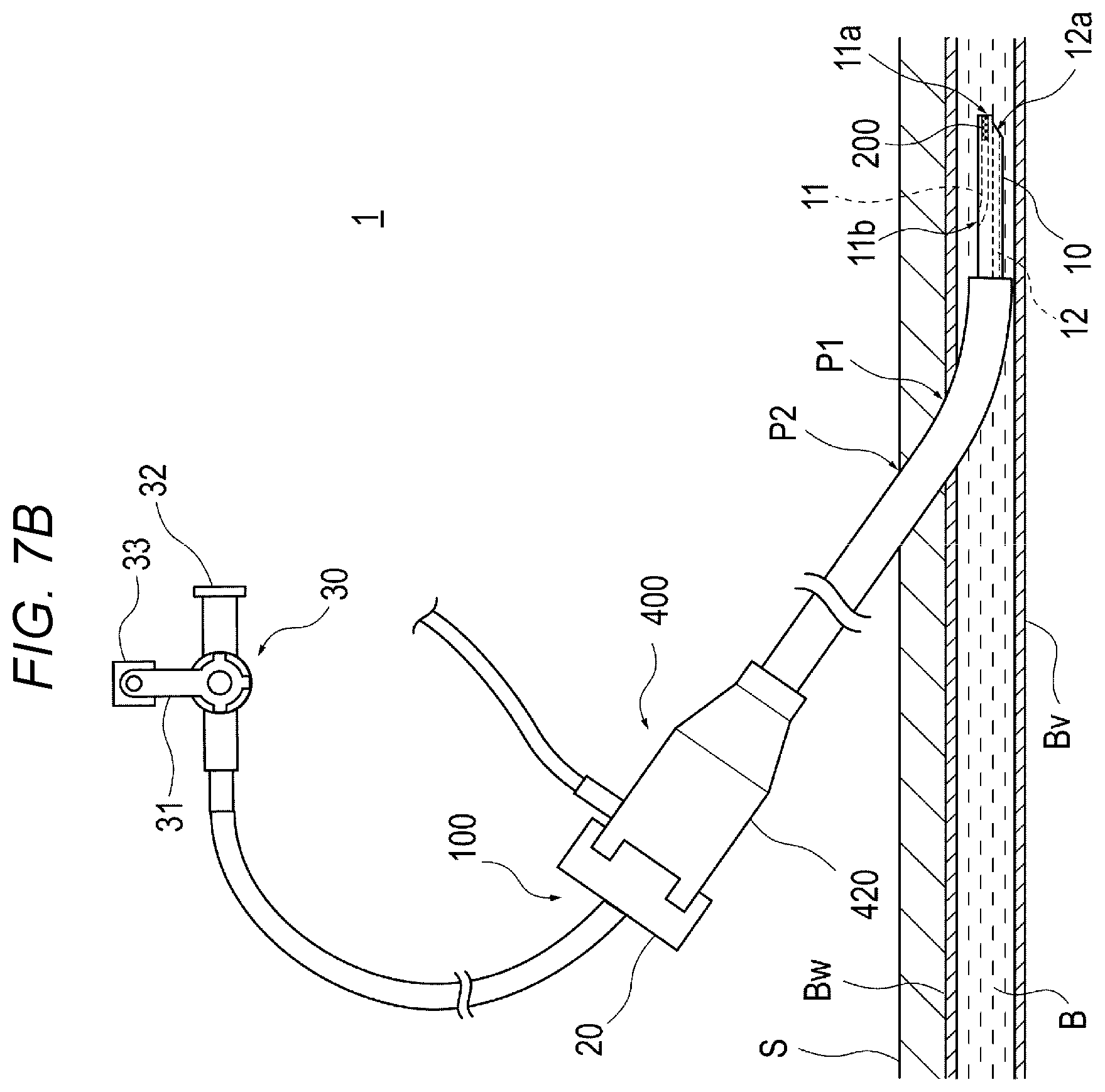 Patent US12616458 Figure 8 – Adhesive material injection device