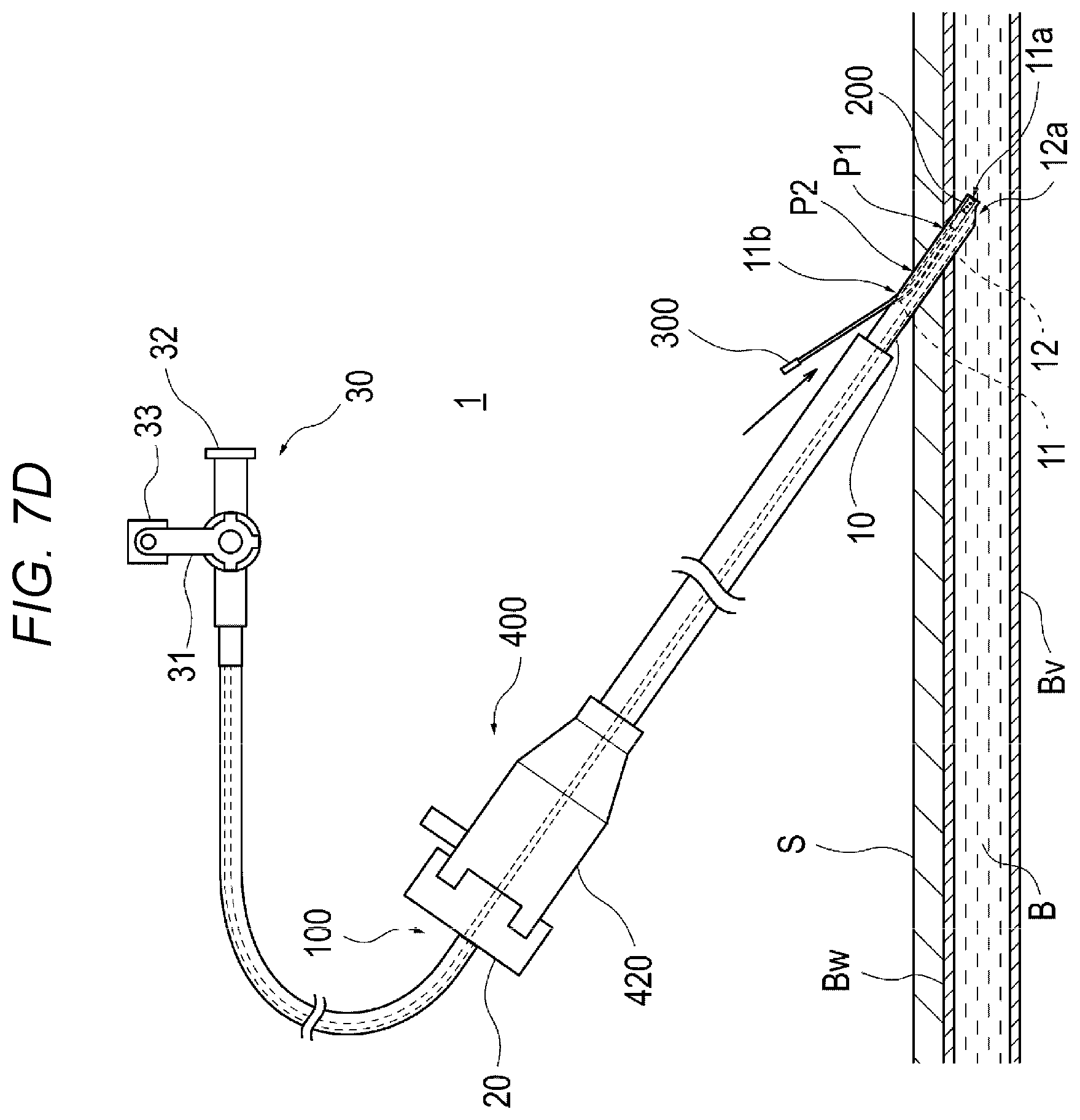 Patent US12616458 Figure 10 – Adhesive material injection device