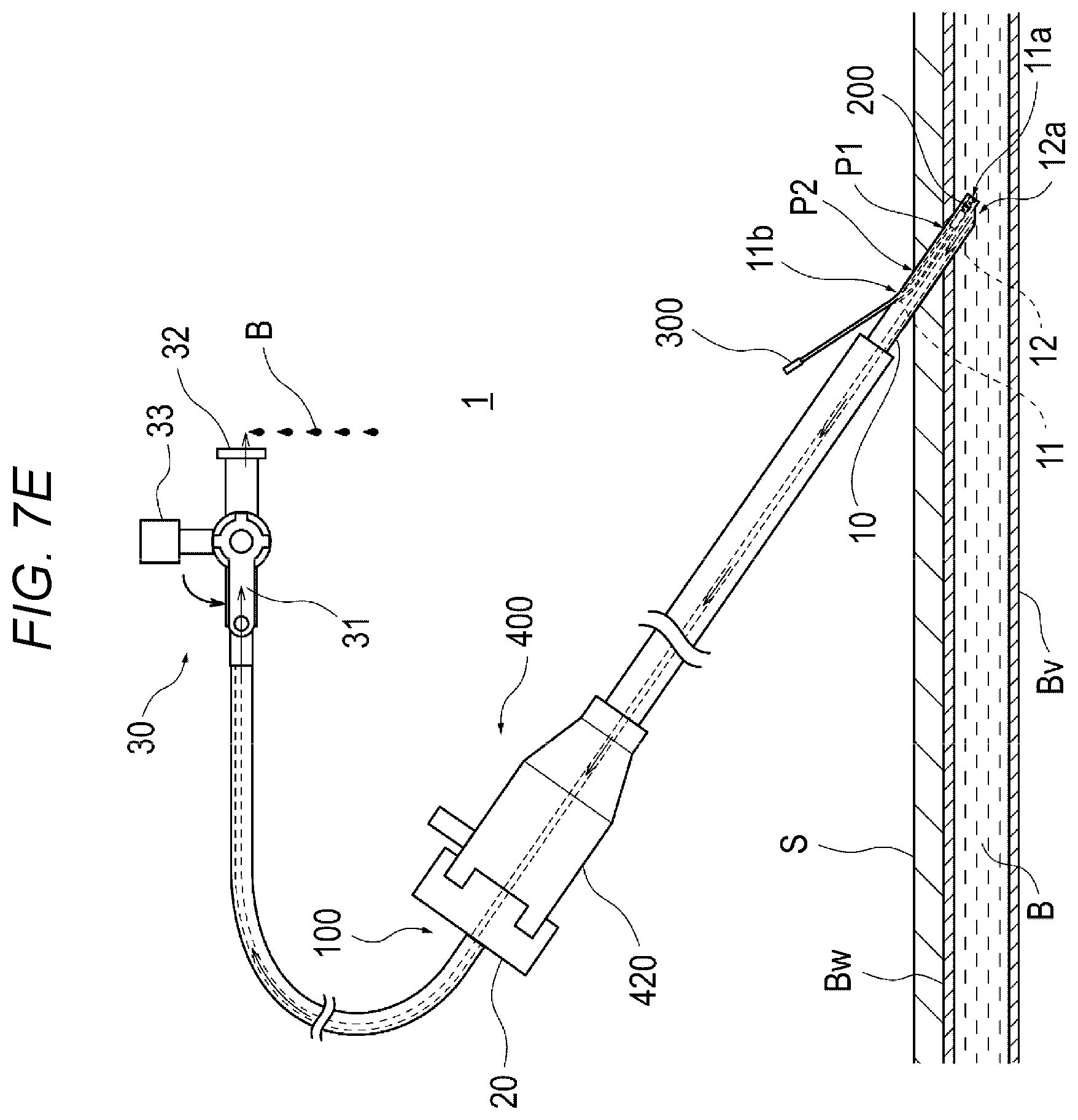 Patent US12616458 Figure 11 – Adhesive material injection device