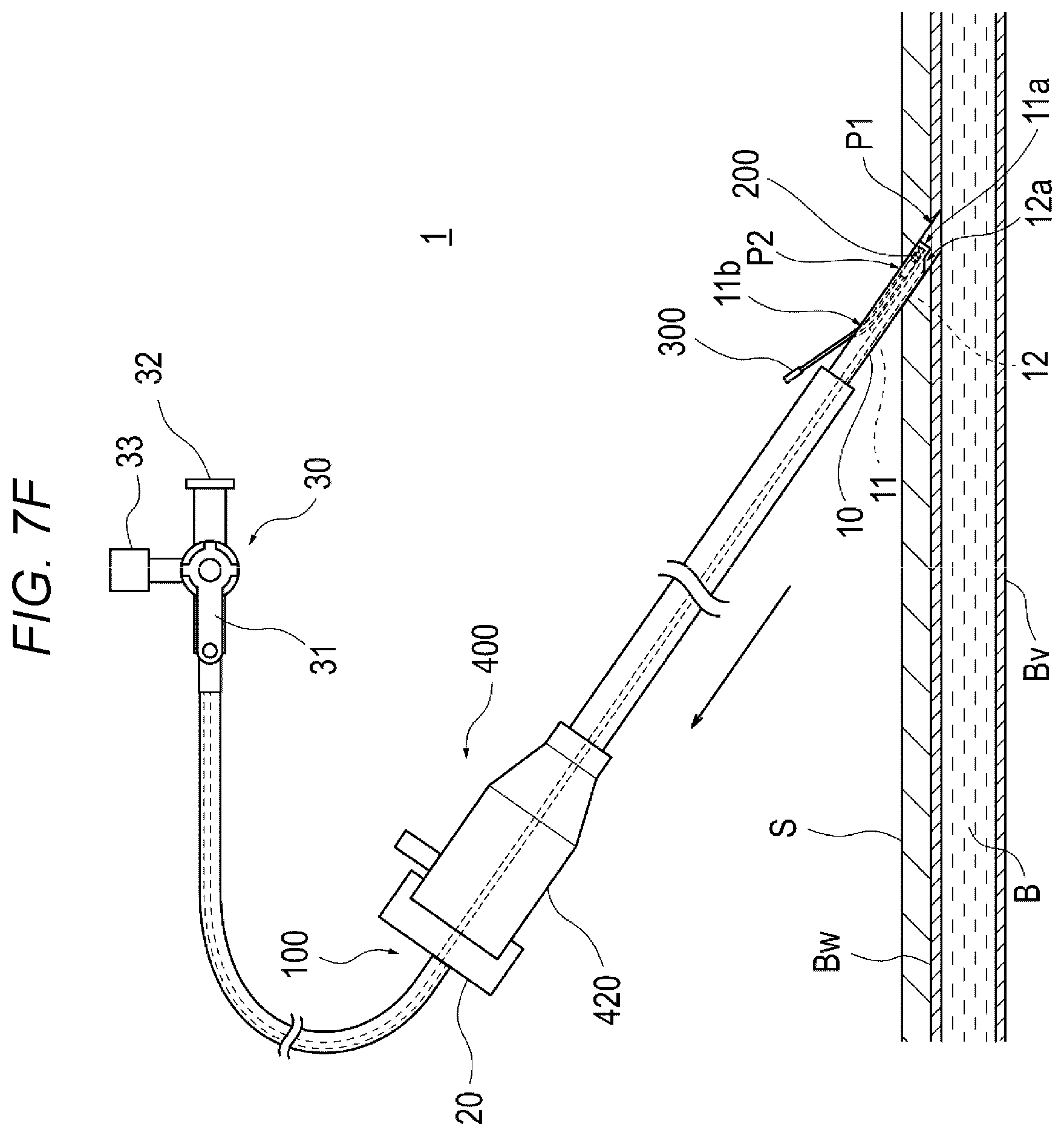 Patent US12616458 Figure 12 – Adhesive material injection device