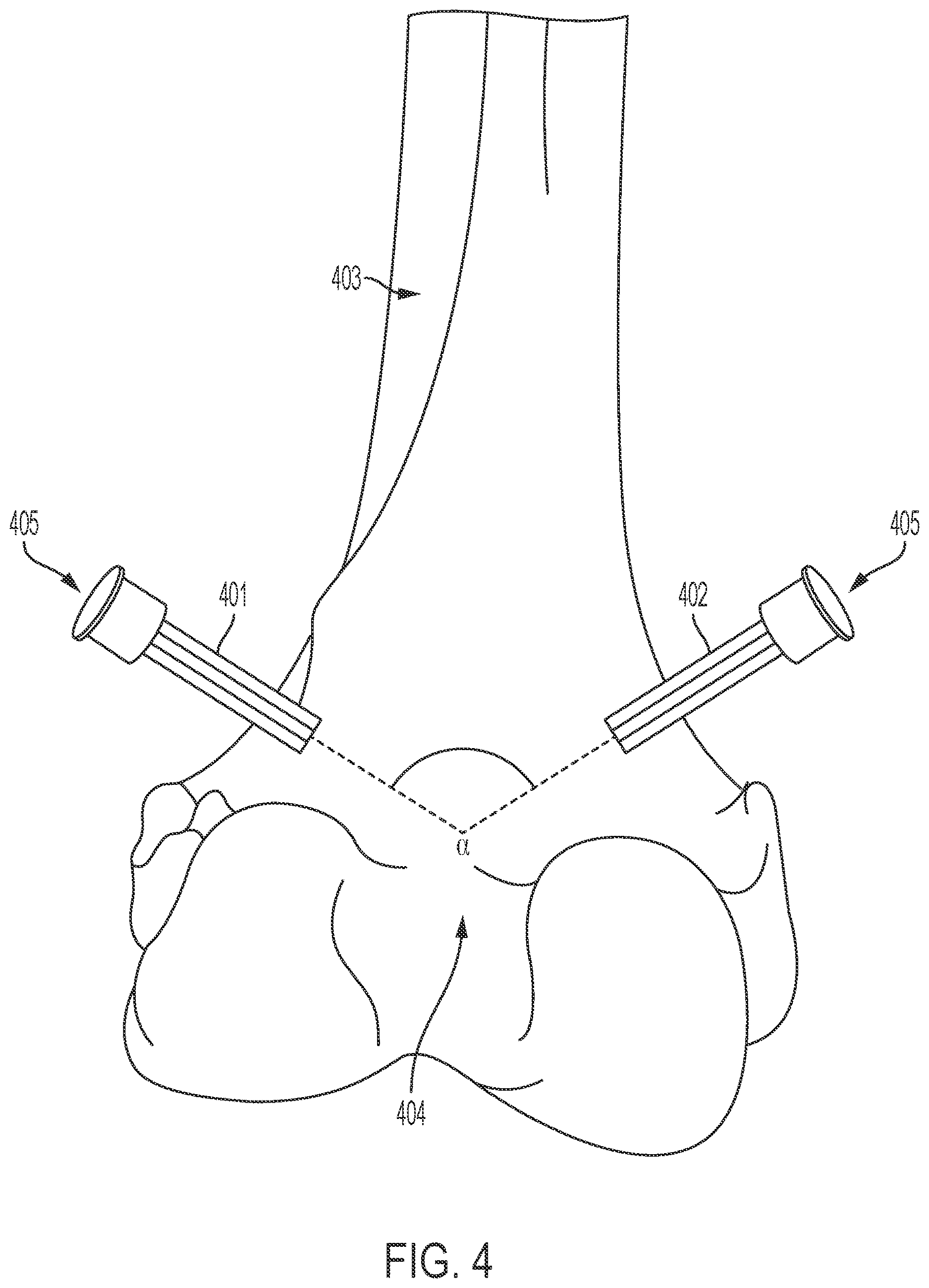 Patent US12616460 Figure 4 – Knee tensioner with digital force and displacement sensing