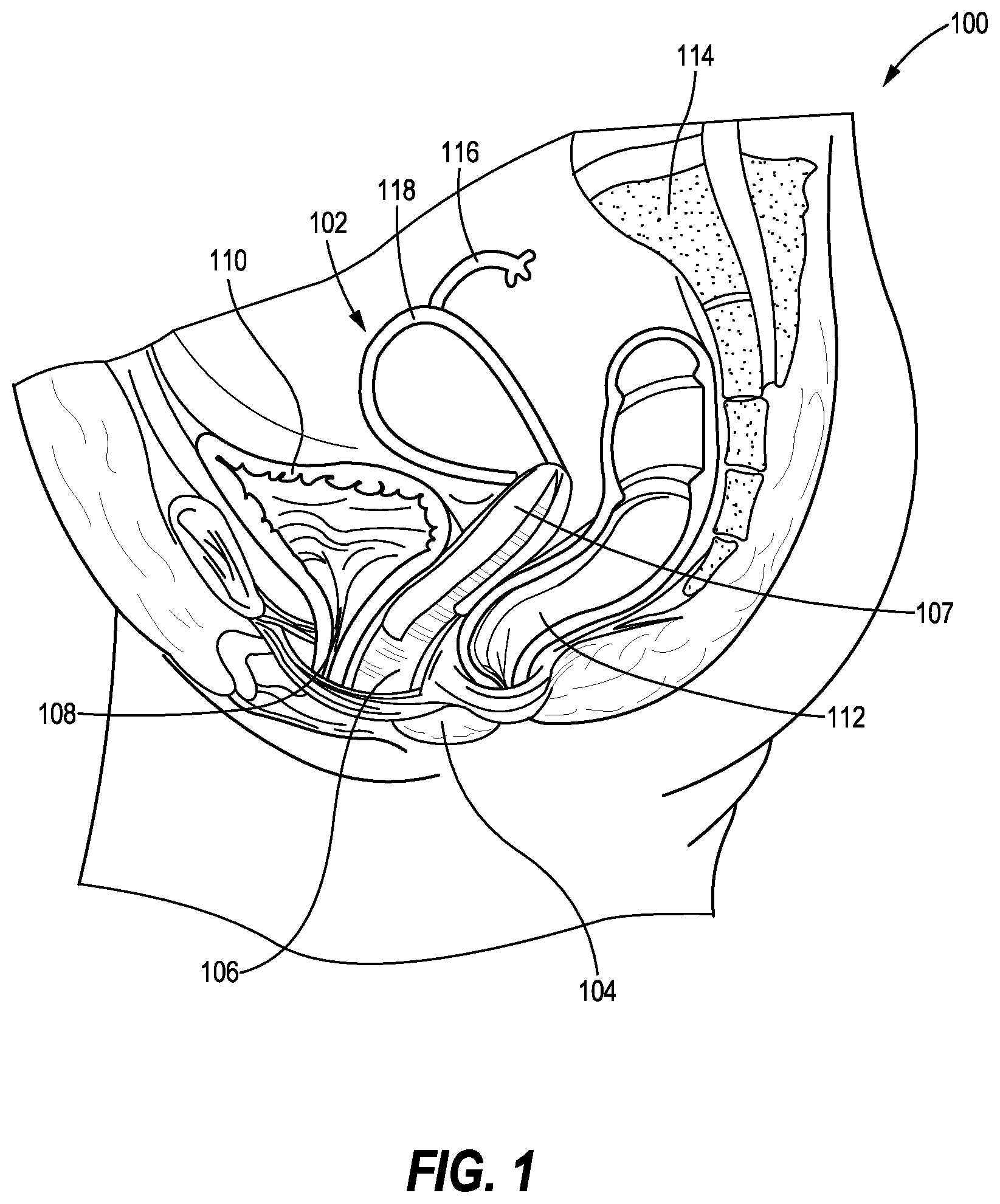 Patent US12616461 Figure 1 – Method of suturing a prosthetic to human tissue